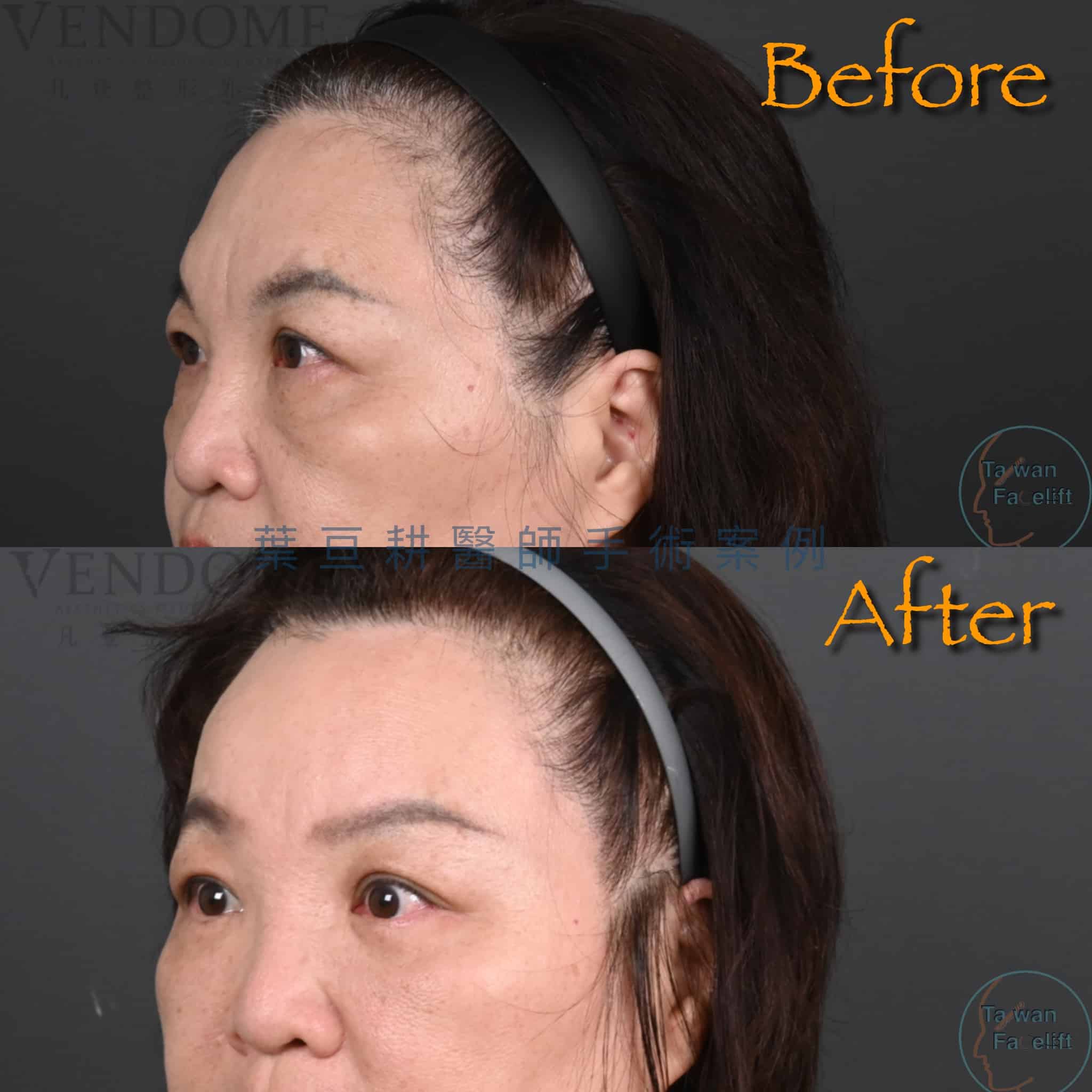 台南葉亘耕醫師內視鏡前額拉皮與前額補脂手術後，額頭平滑飽滿，皺紋改善。