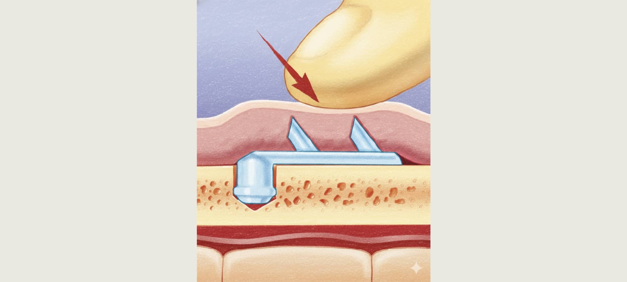 內視鏡提眉後有可能摸到五爪鉤尖刺感 會自行消退改善