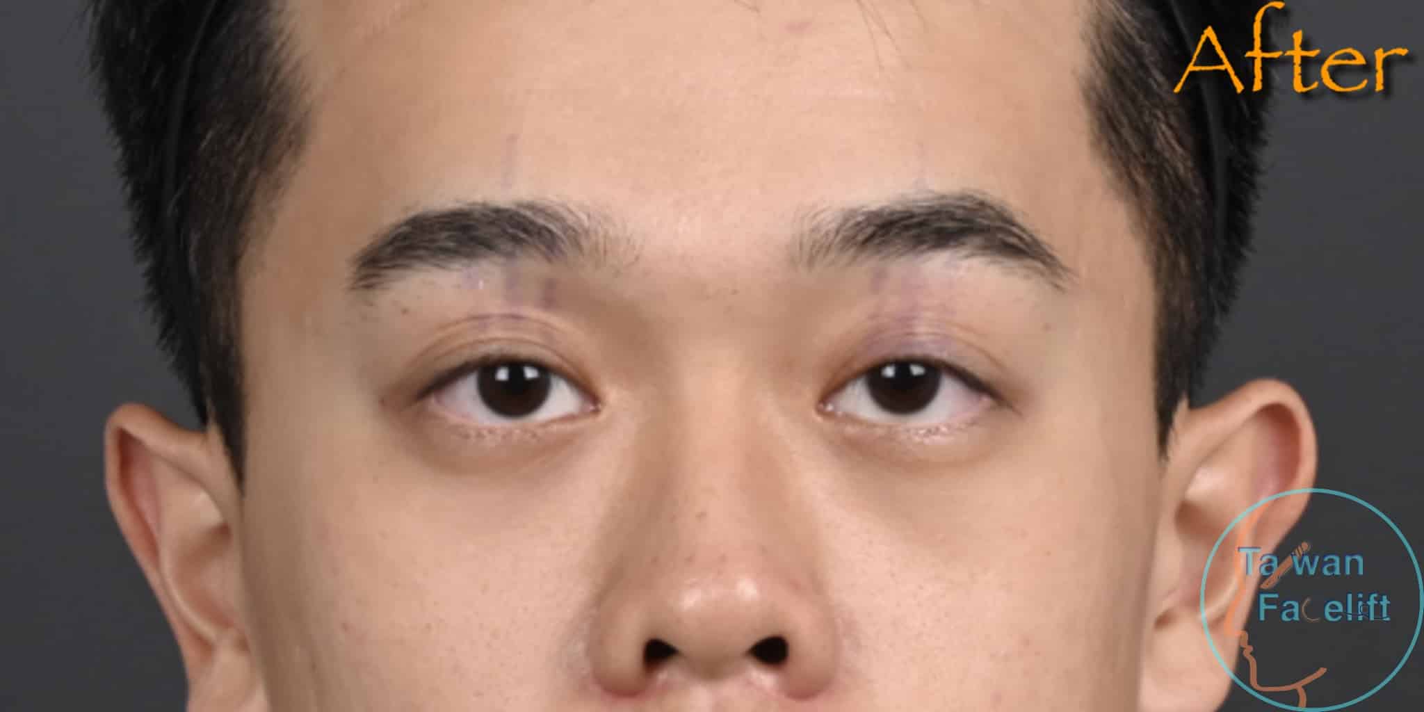 台南葉亘耕醫師提眼瞼肌手術後，林先生黑眼珠露出，雙眼皮內斂自然，眼神有神。