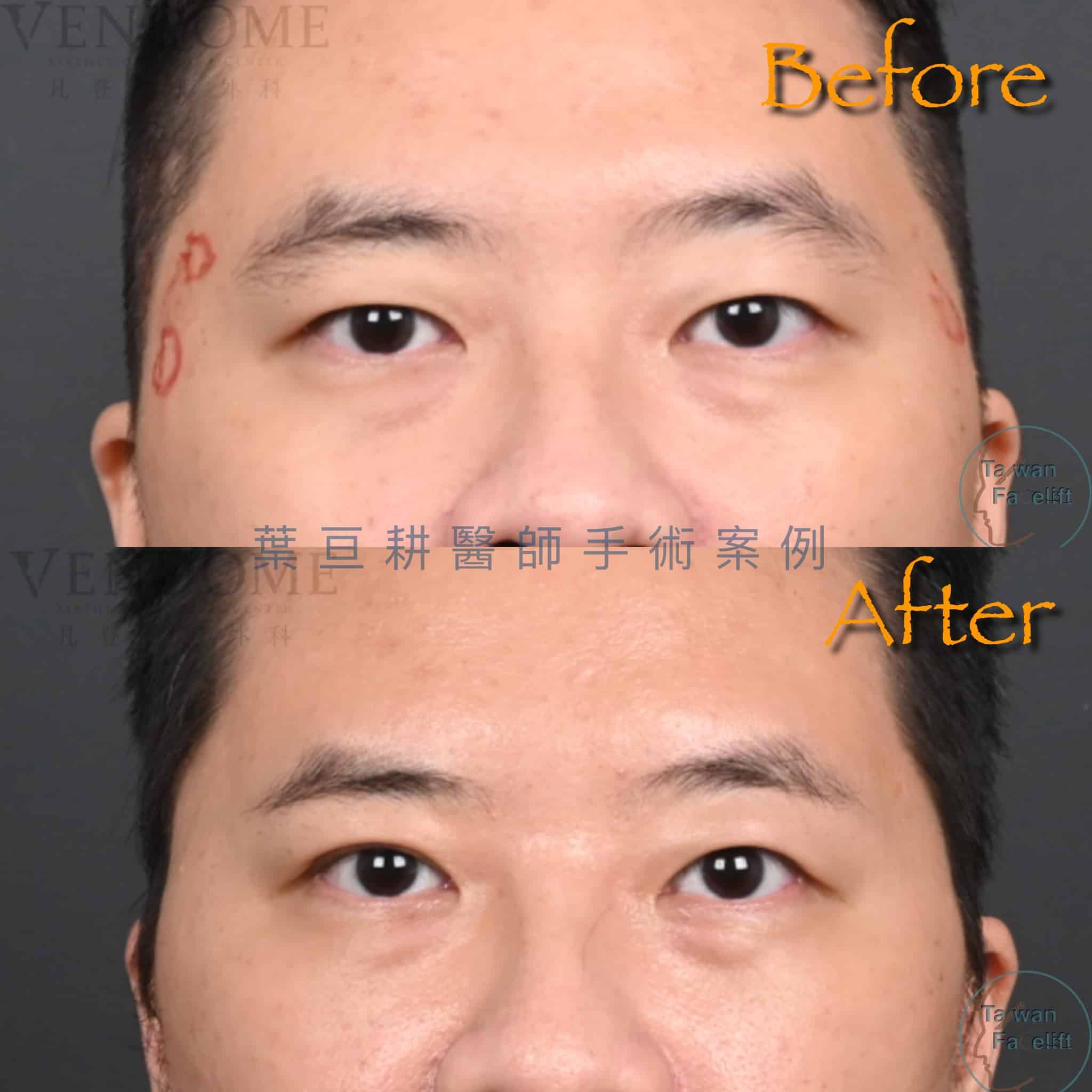 男性雙眼皮重點是有神內斂