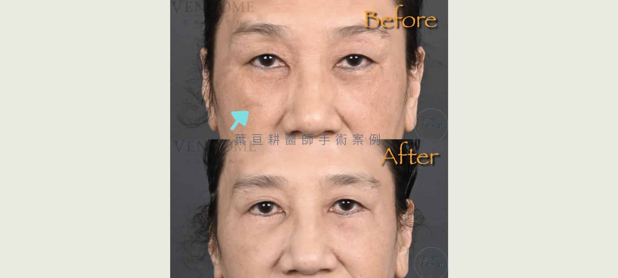 眼袋手術失敗救援指南:後悔了怎麼辦?專家解析眼袋重修時機與眼瞼外翻修復 2 眼下修皮不足與填充位置不當 可以藉由二次手術調整改善