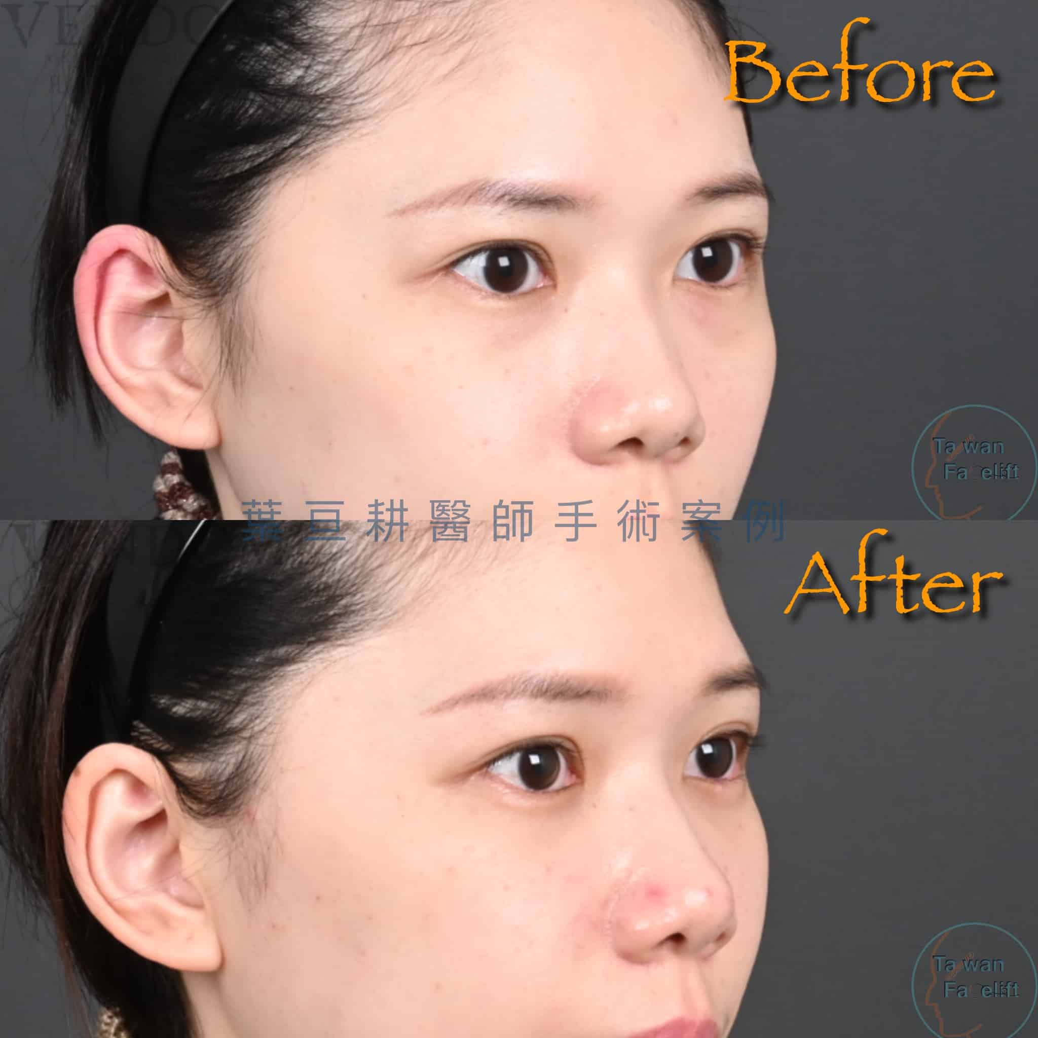 無痕眼袋手術與精準補脂後，眼下飽滿，更顯青春光彩。