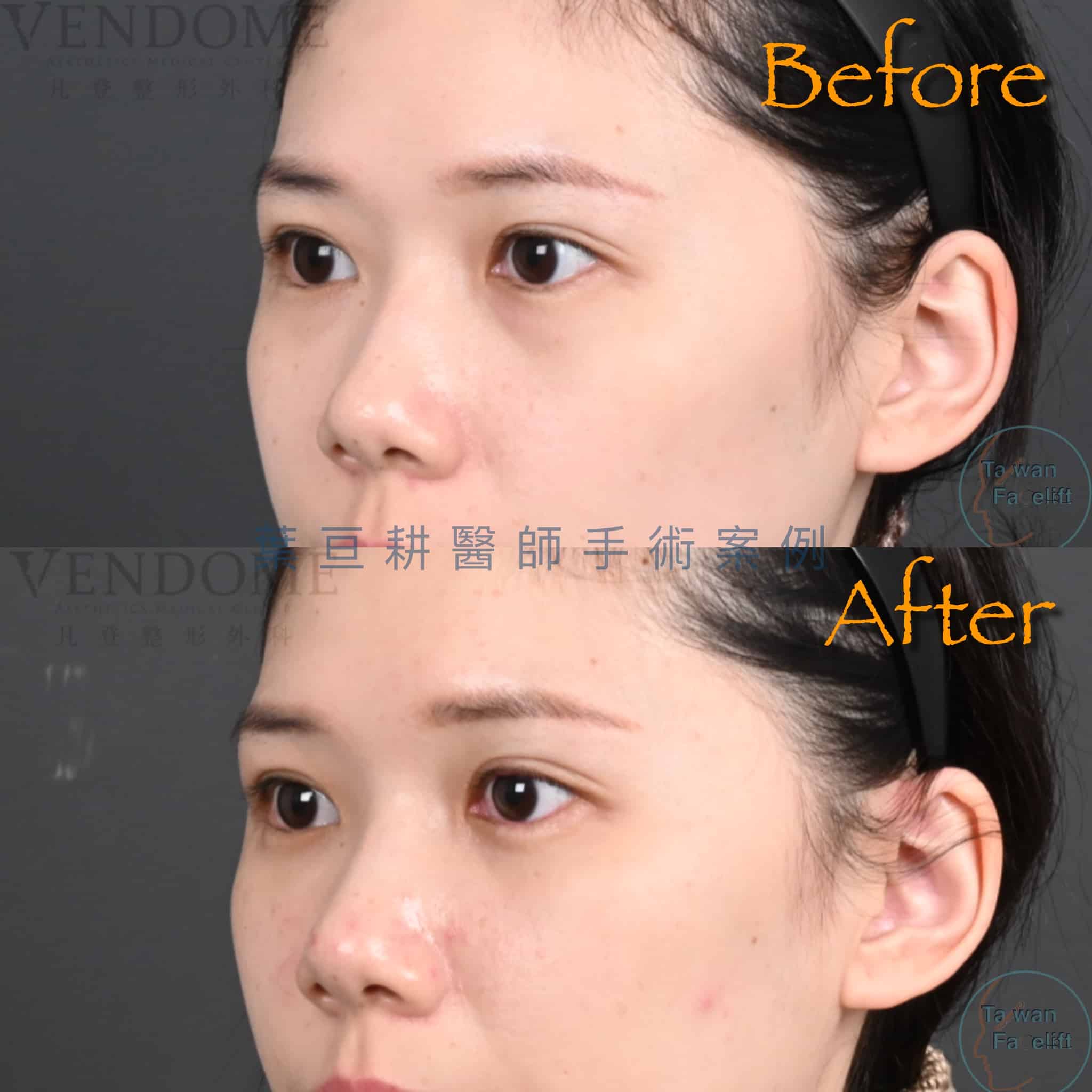 無痕眼袋手術與精準補脂後，眼下飽滿，更顯青春光彩。