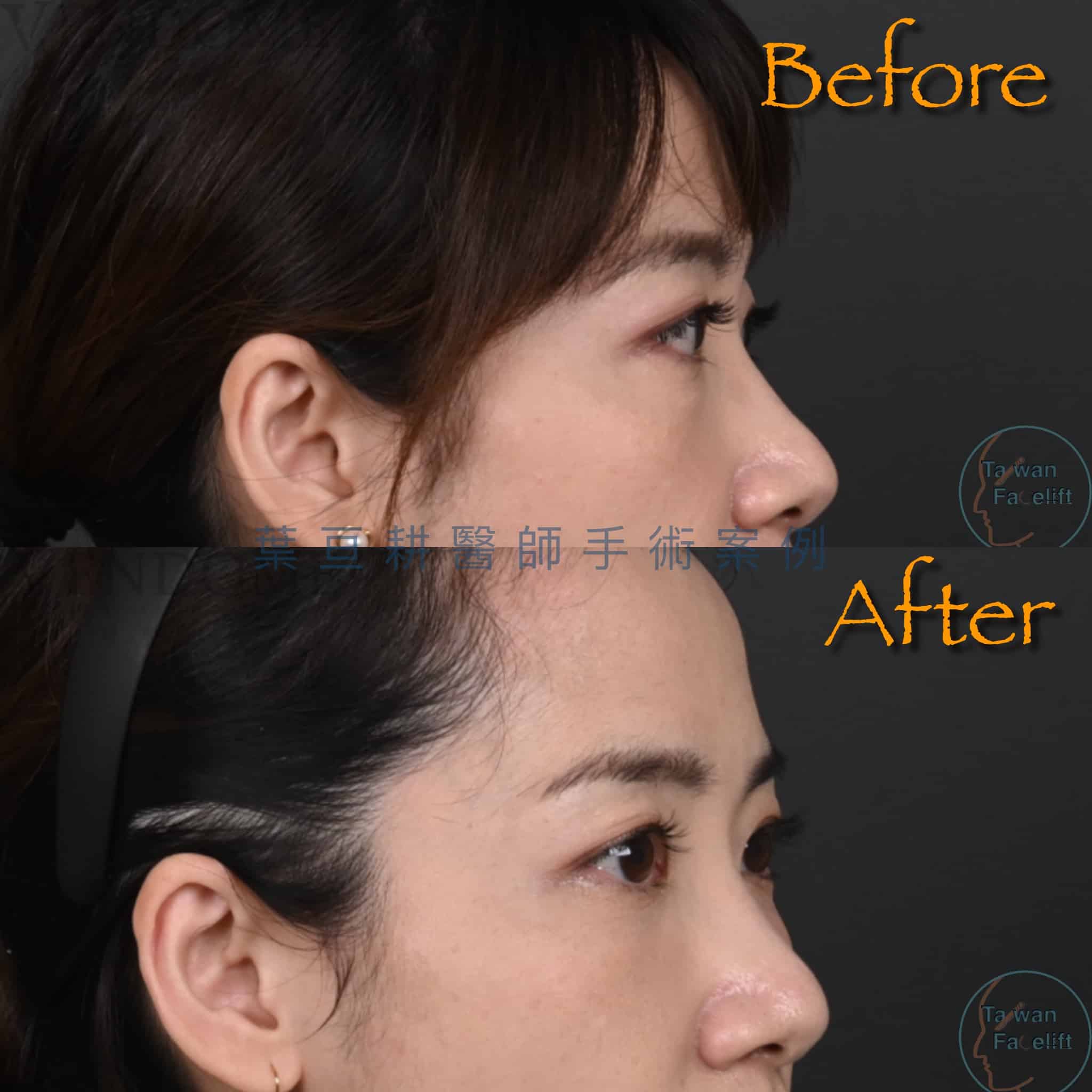 無痕眼袋手術與補脂後，眼下平滑，重拾少女氣息。