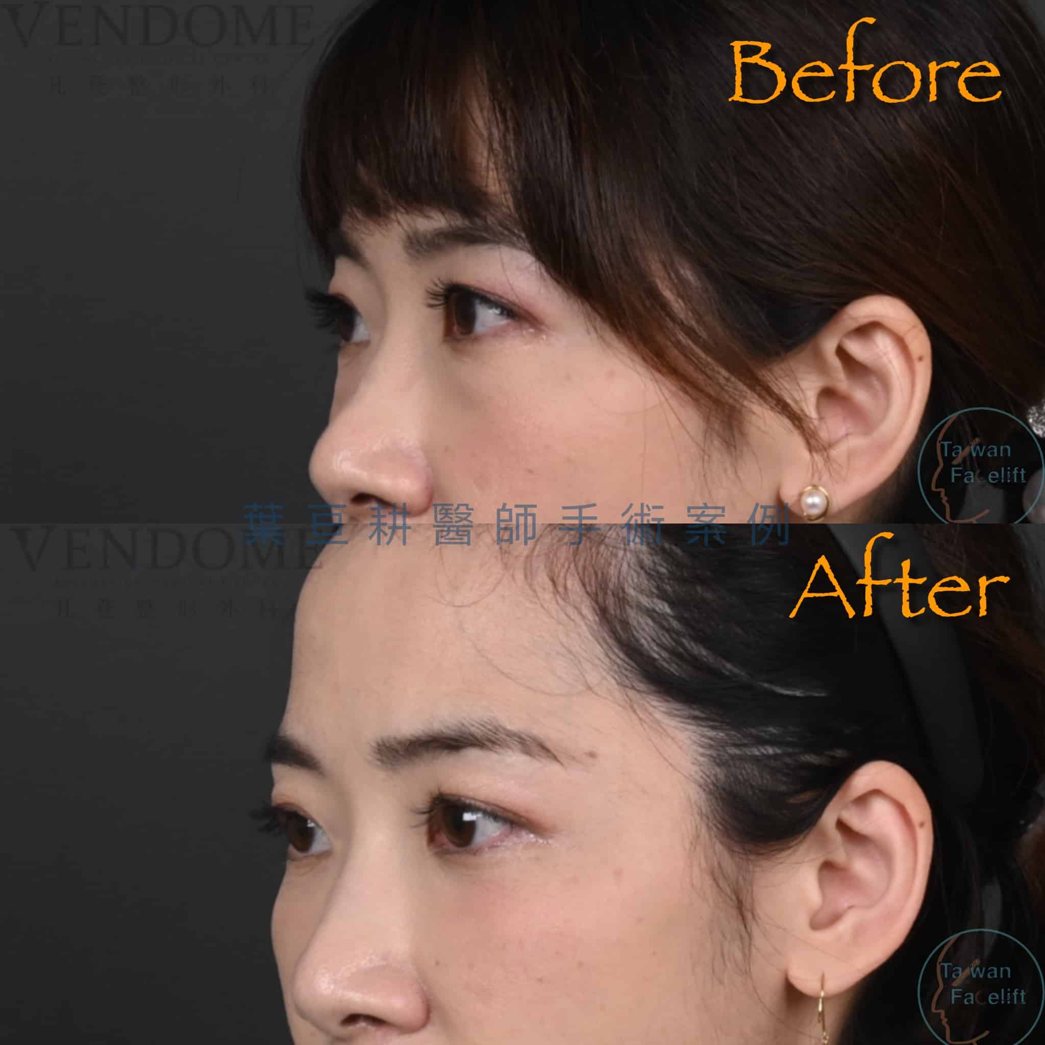 無痕眼袋手術與補脂後，眼下平滑，重拾少女氣息。