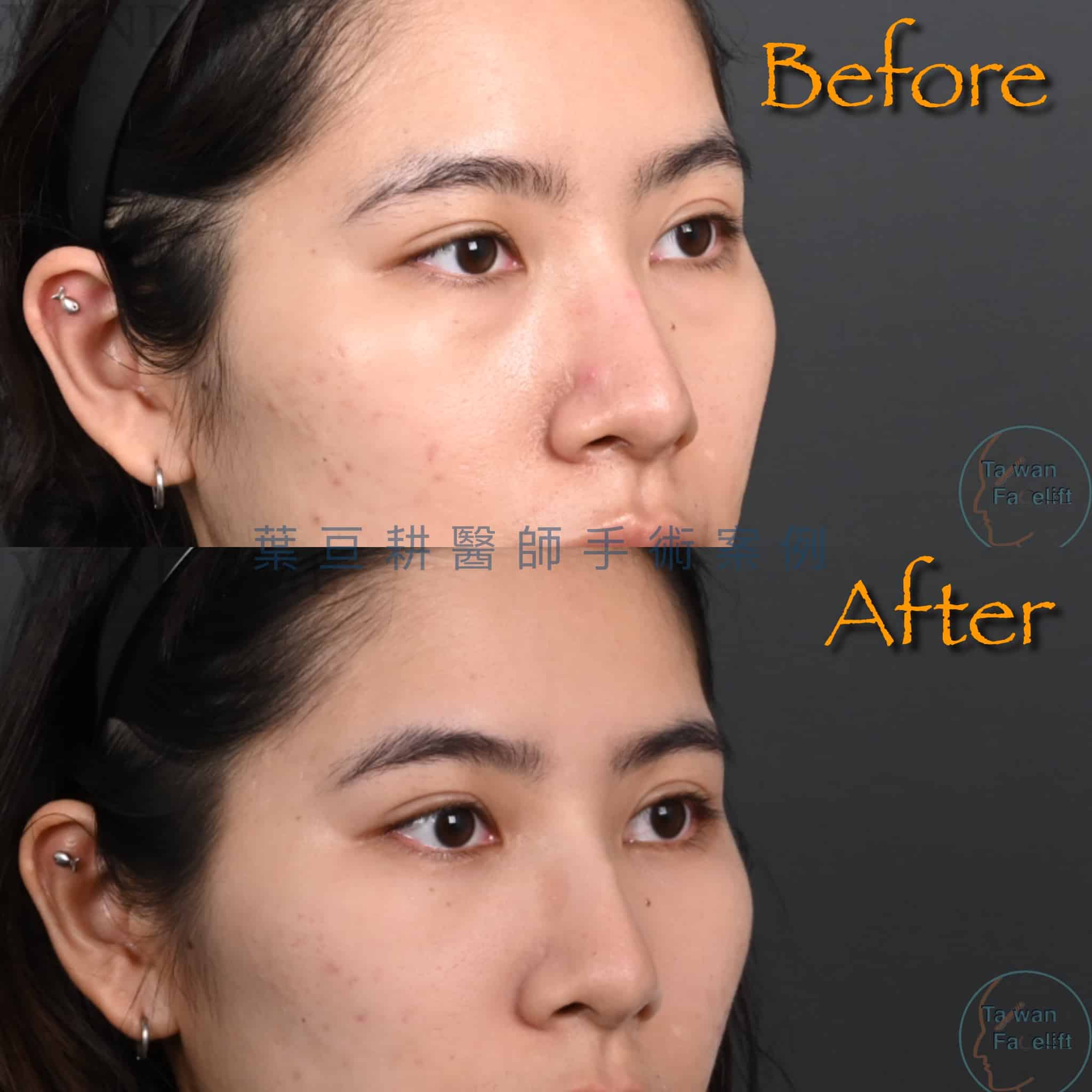 無痕眼袋手術與補脂後，眼下恢復平滑，眼神清新自信。