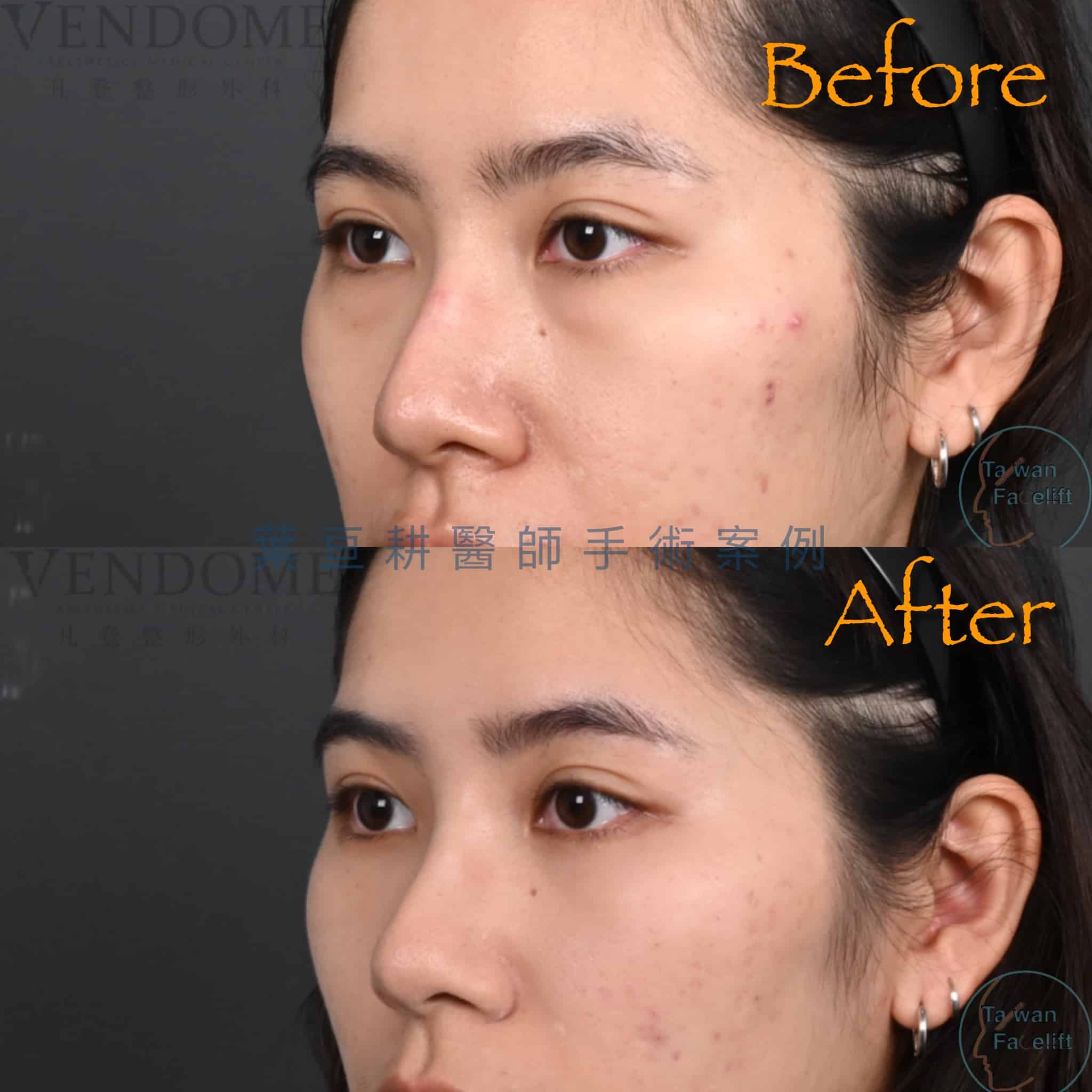 無痕眼袋手術與補脂後，眼下恢復平滑，眼神清新自信。