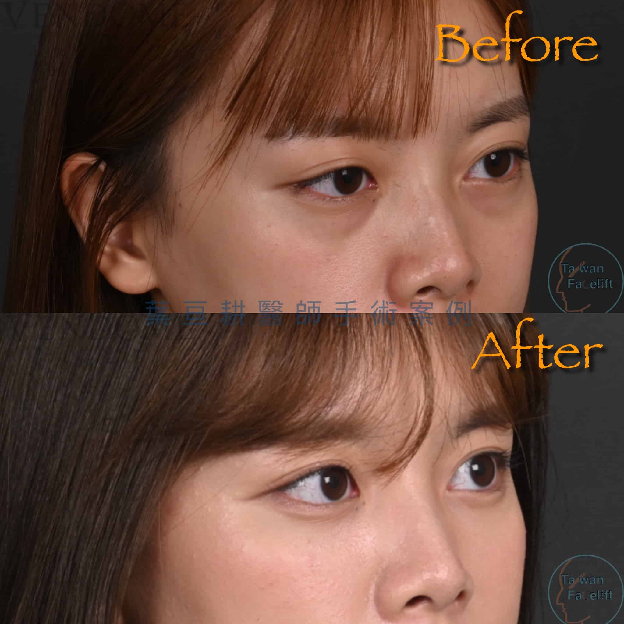 台南葉亘耕醫師眼袋內開手術後，眼袋消除，眼神明亮有神。