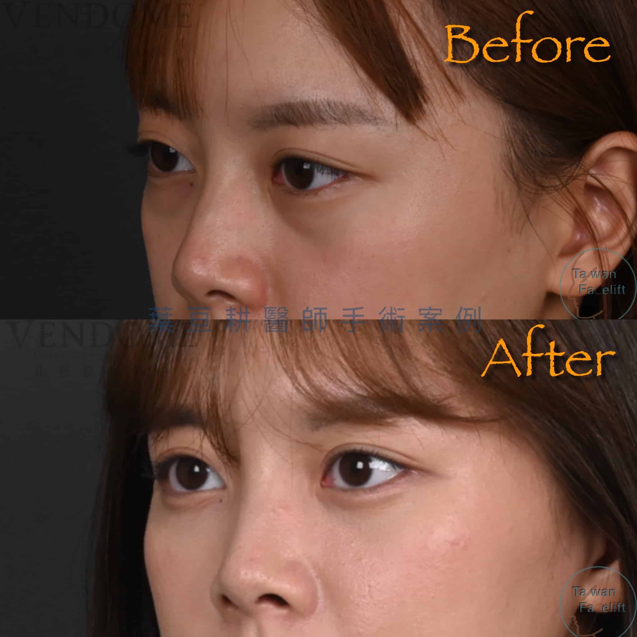 台南葉亘耕醫師眼袋內開手術後，眼袋消除，眼神明亮有神。