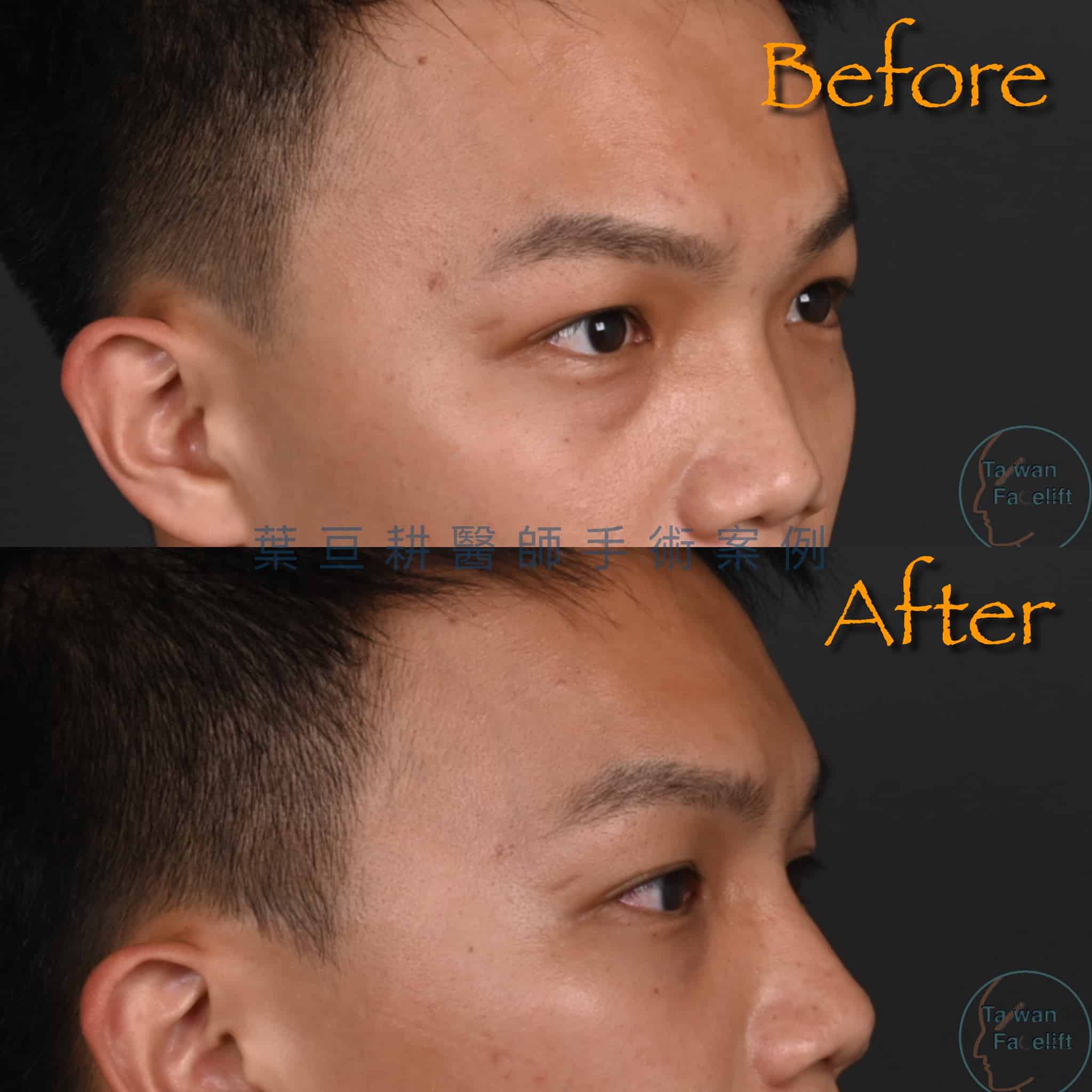 台南葉亘耕醫師男性眼袋內開手術後，眼袋消除，眼神更顯精神與自信。