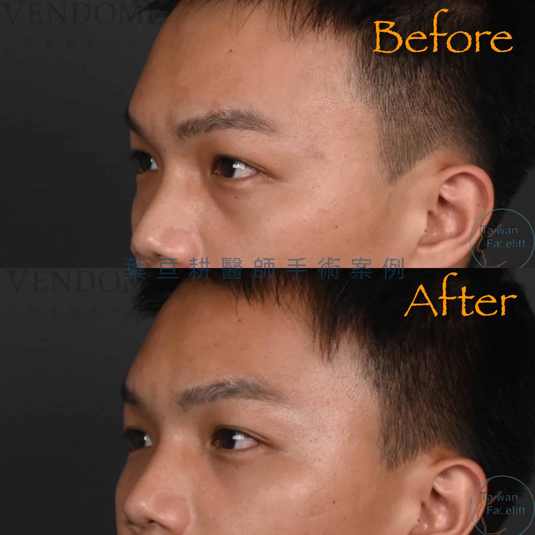 台南葉亘耕醫師男性眼袋內開手術後，眼袋消除，眼神更顯精神與自信。