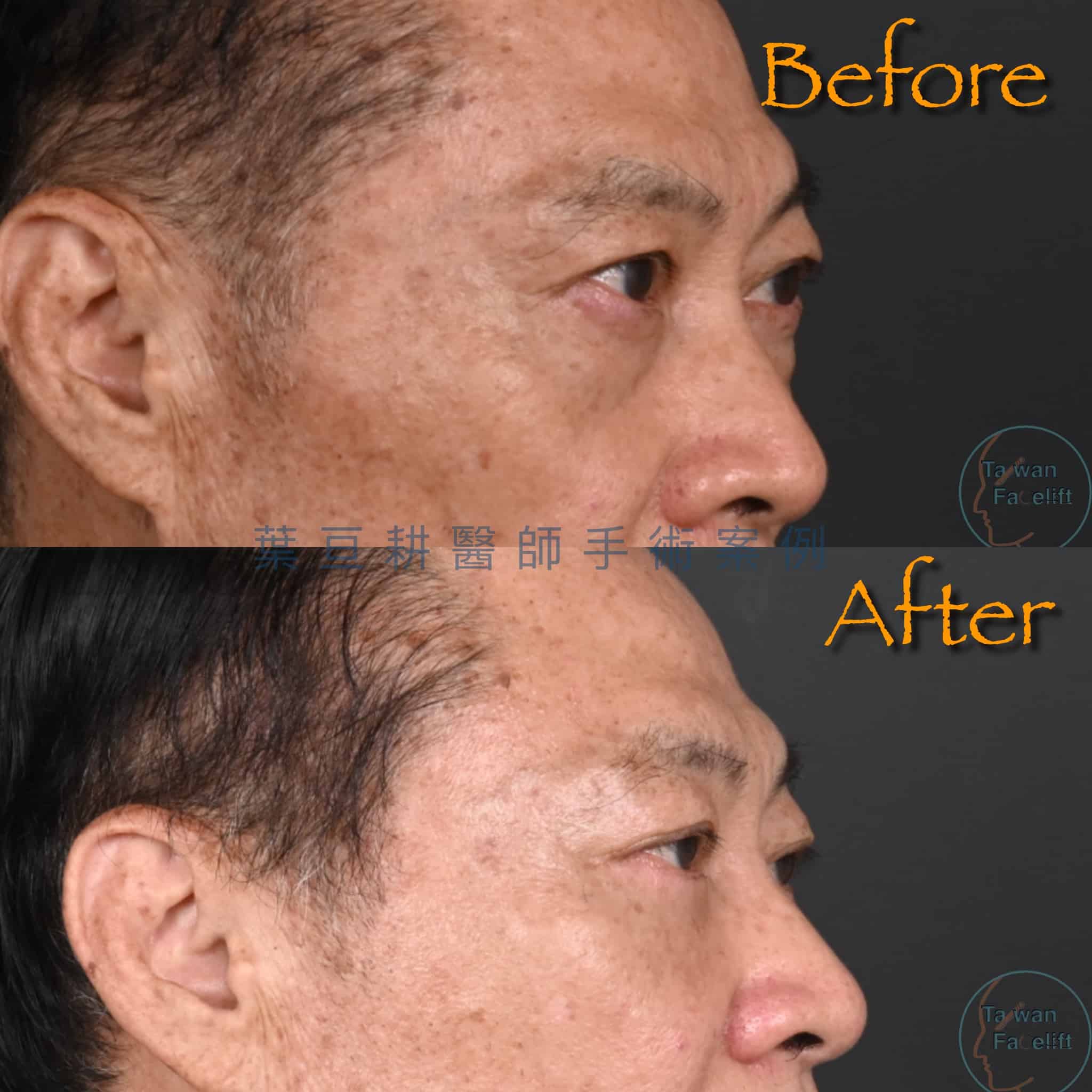 男性眼袋外開手術，讓你重回年輕時期幹練的眼神