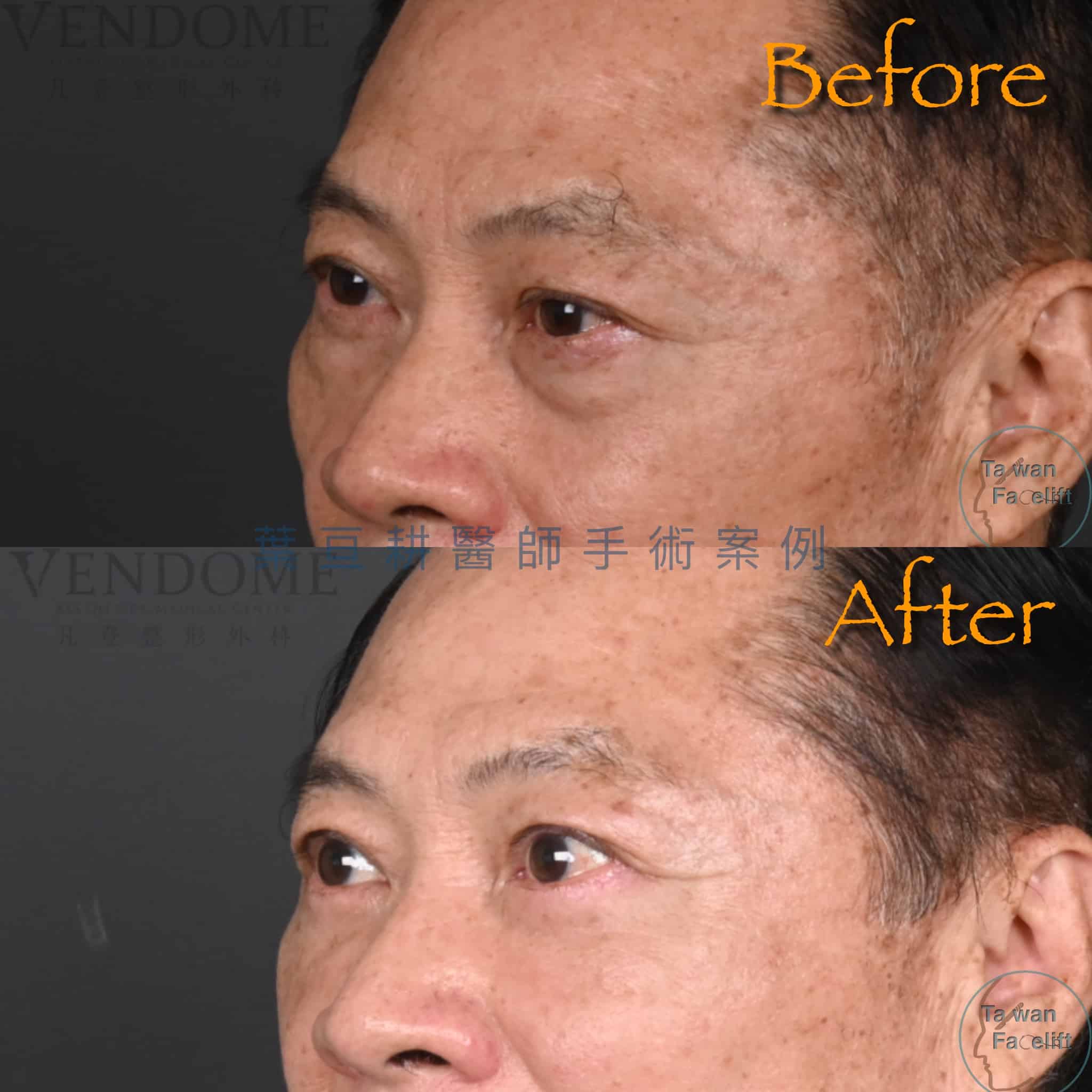 男性眼袋外開手術，讓你重回年輕時期幹練的眼神