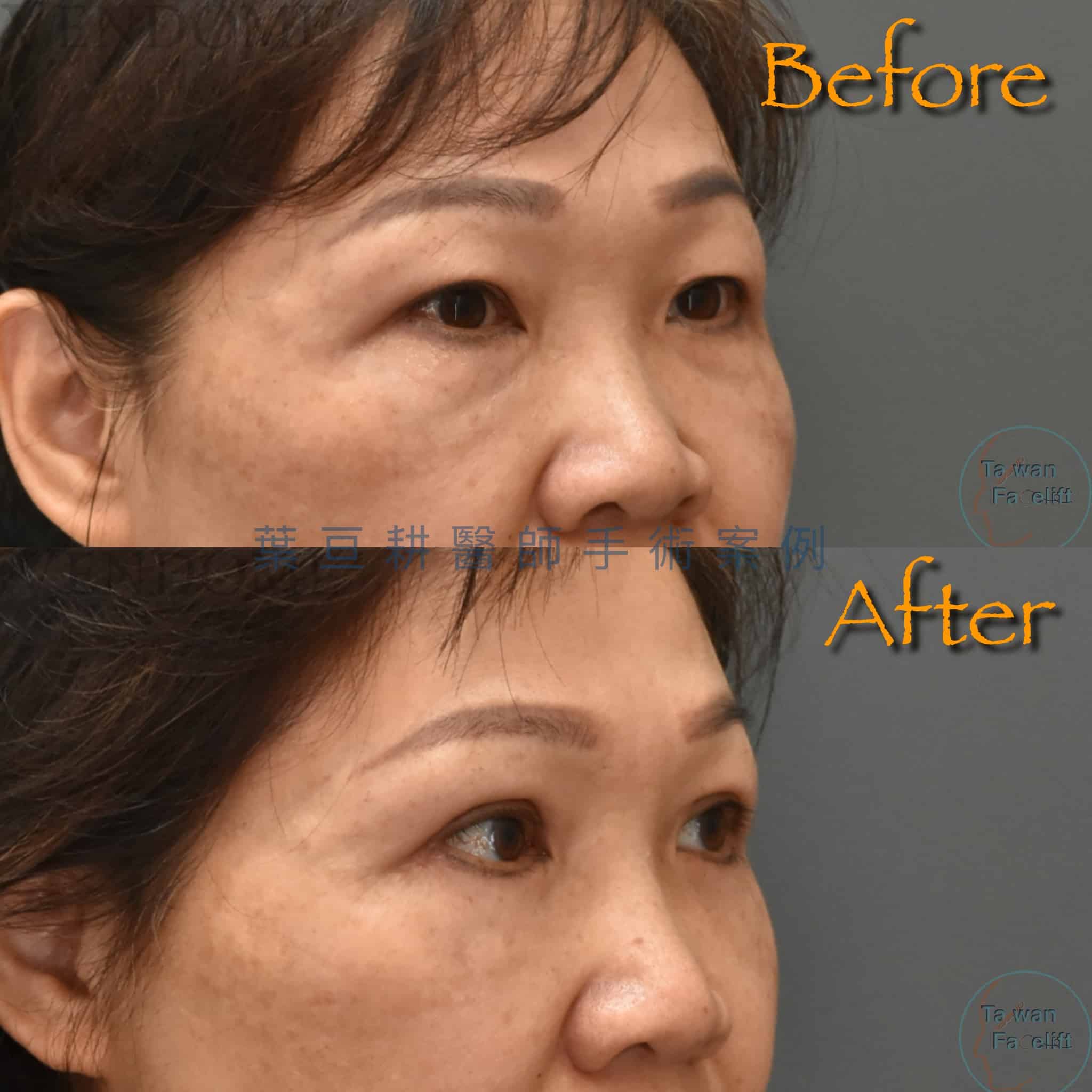 眼周手術後，眼袋消失、眼神明亮，蘋果肌飽滿更顯年輕。