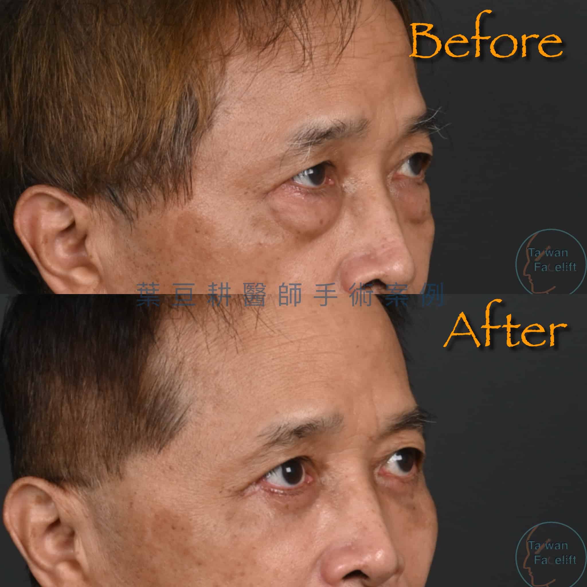 台南葉亘耕醫師男性眼袋外開手術後，眼袋消除，眼神更顯精神與精明。