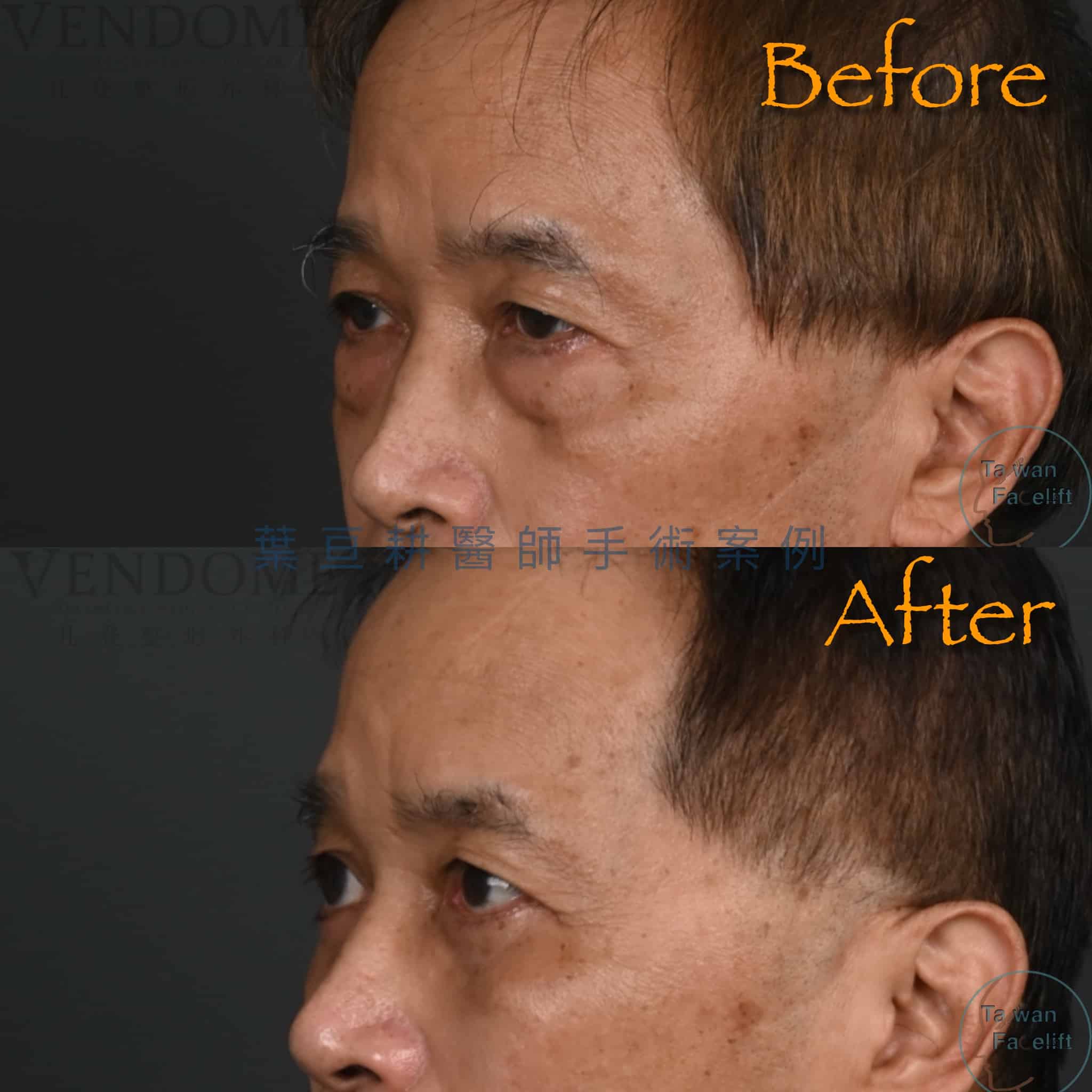 台南葉亘耕醫師男性眼袋外開手術後，眼袋消除，眼神更顯精神與精明。