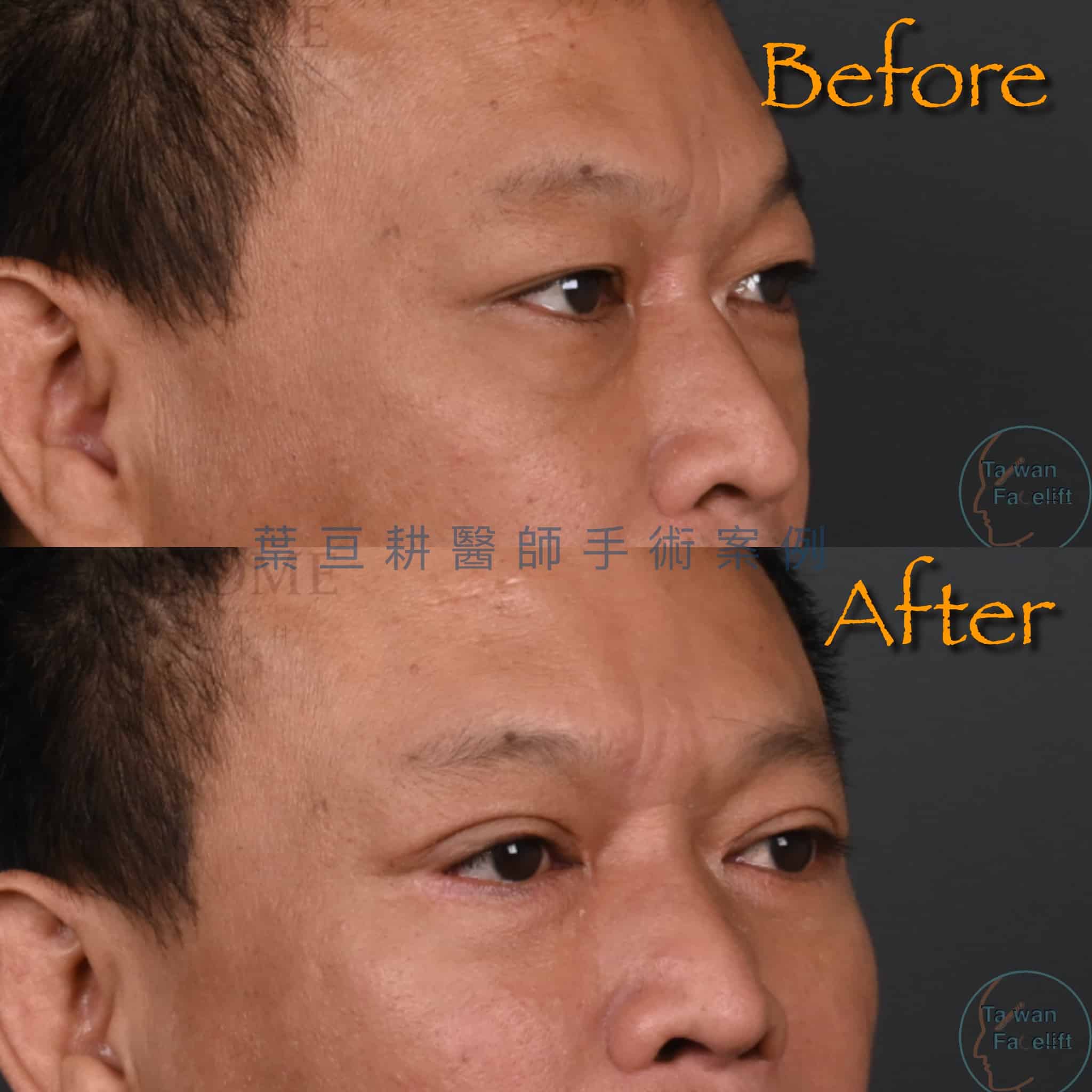 男性眼周年輕化手術後，眼神變得緊實有型，更顯年輕自信。