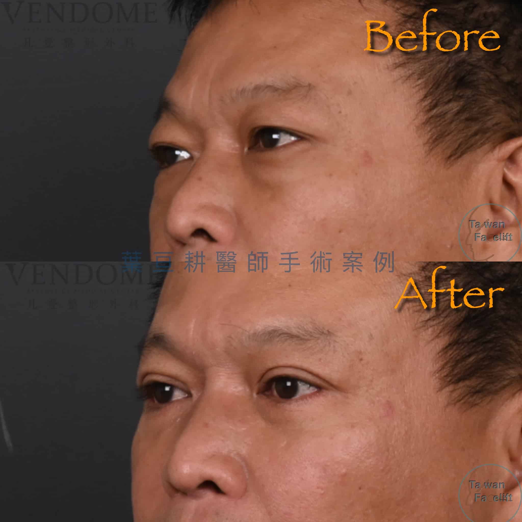 男性眼周年輕化手術後，眼神變得緊實有型，更顯年輕自信。