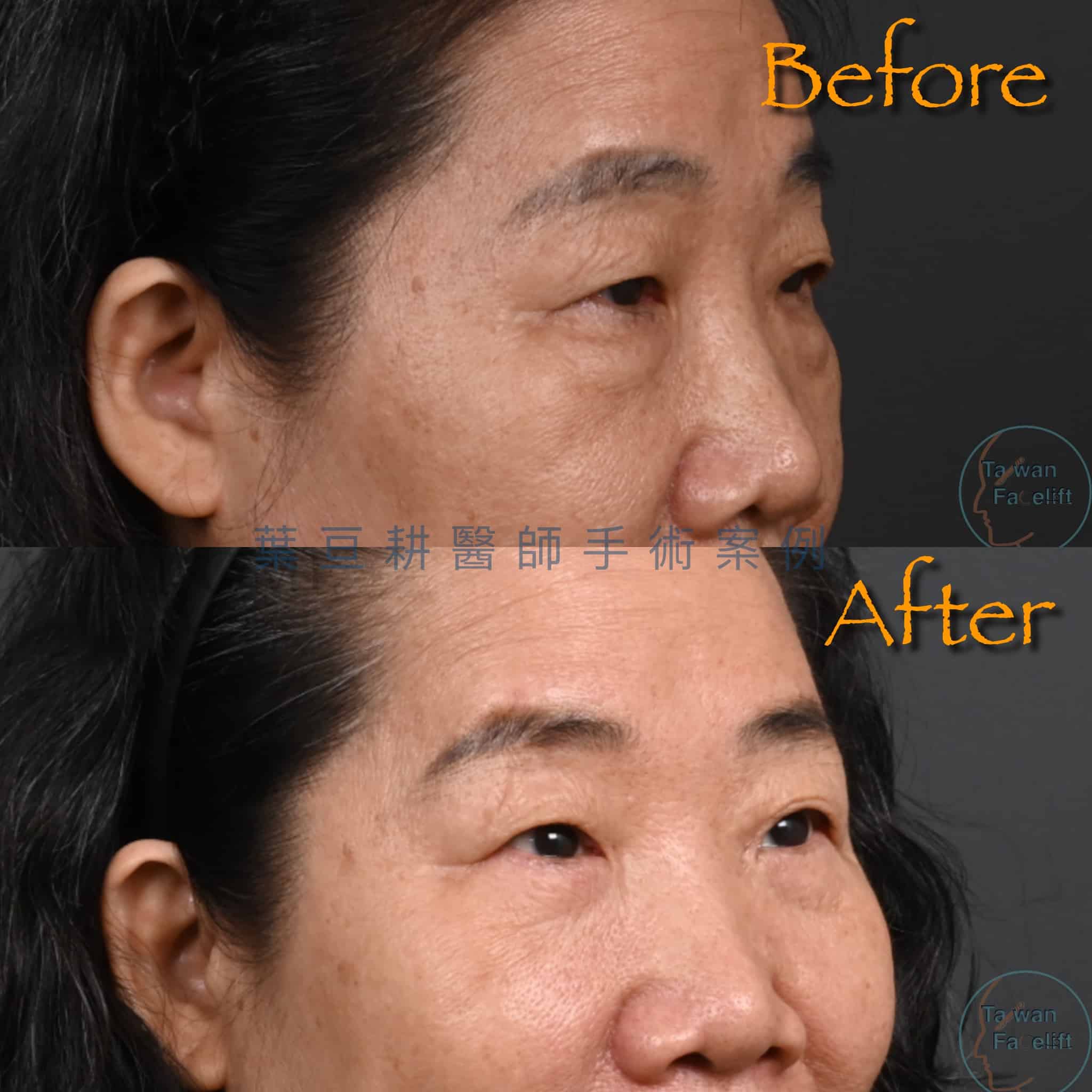 台南葉亘耕醫師眼袋外開手術後，眼袋消除，眼周緊緻拉提。