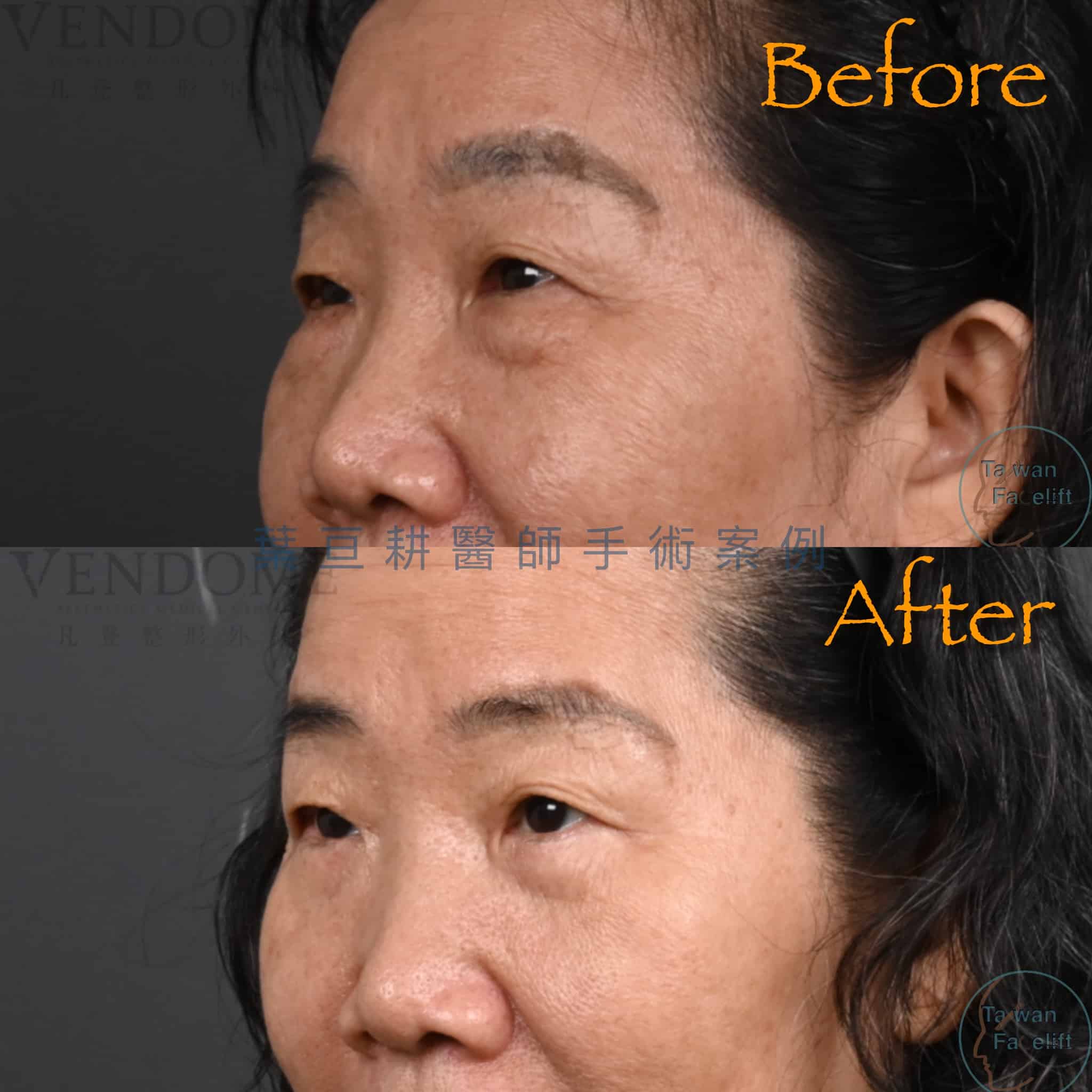 台南葉亘耕醫師眼袋外開手術後，眼袋消除，眼周緊緻拉提。