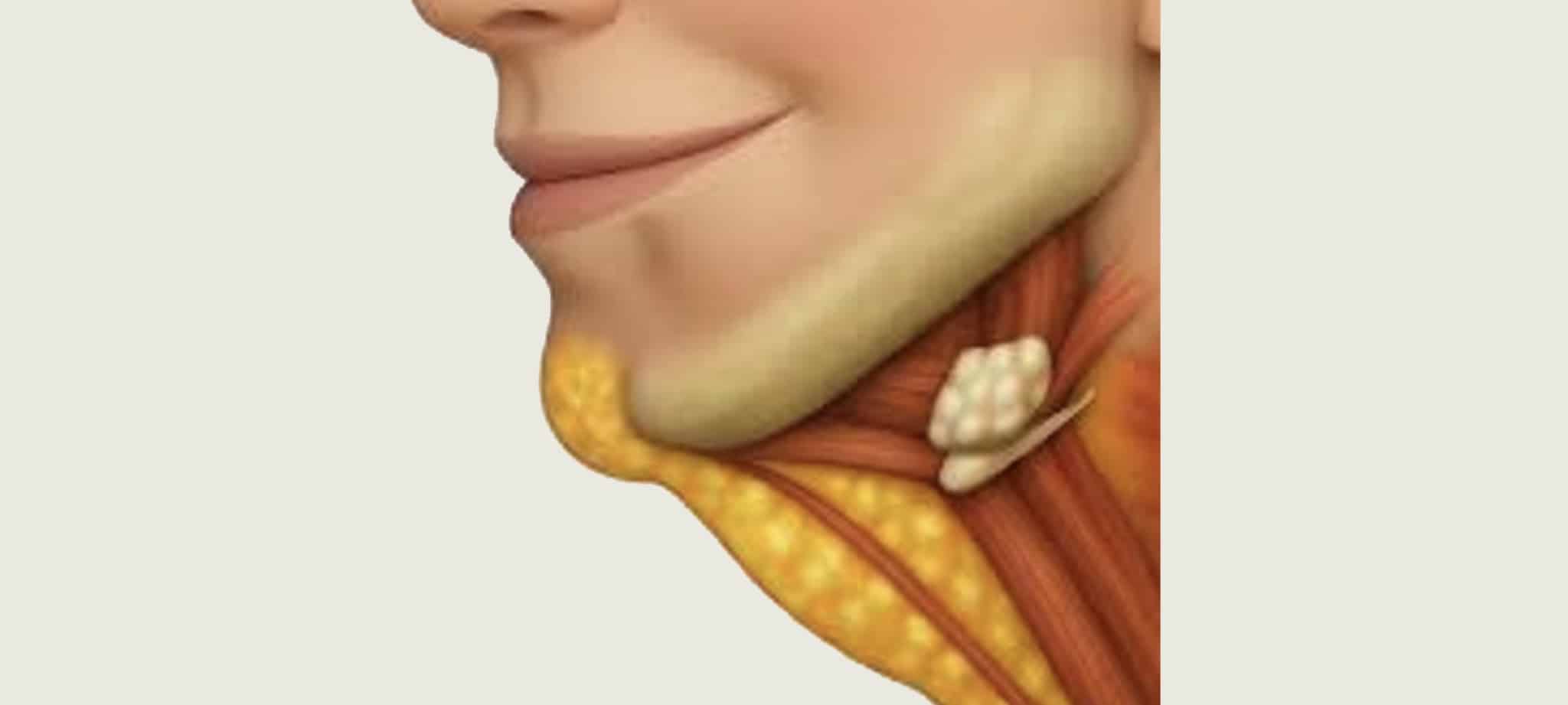 雙下巴成因：脂肪堆積與擴頸肌鬆弛解剖圖