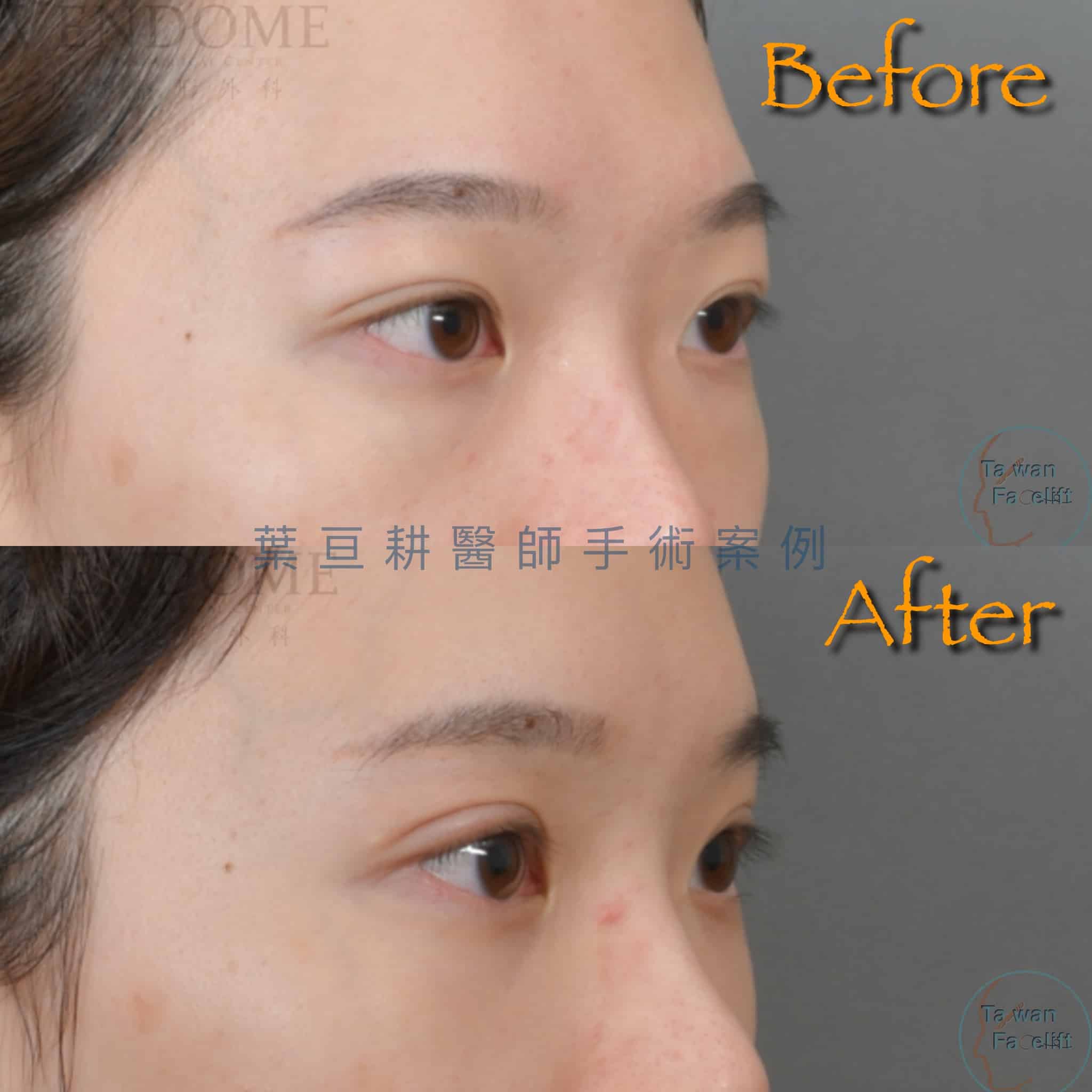 台南葉亘耕醫師雙眼皮重修手術後，調整提眼瞼肌與割雙眼皮，眼神明亮有神。
