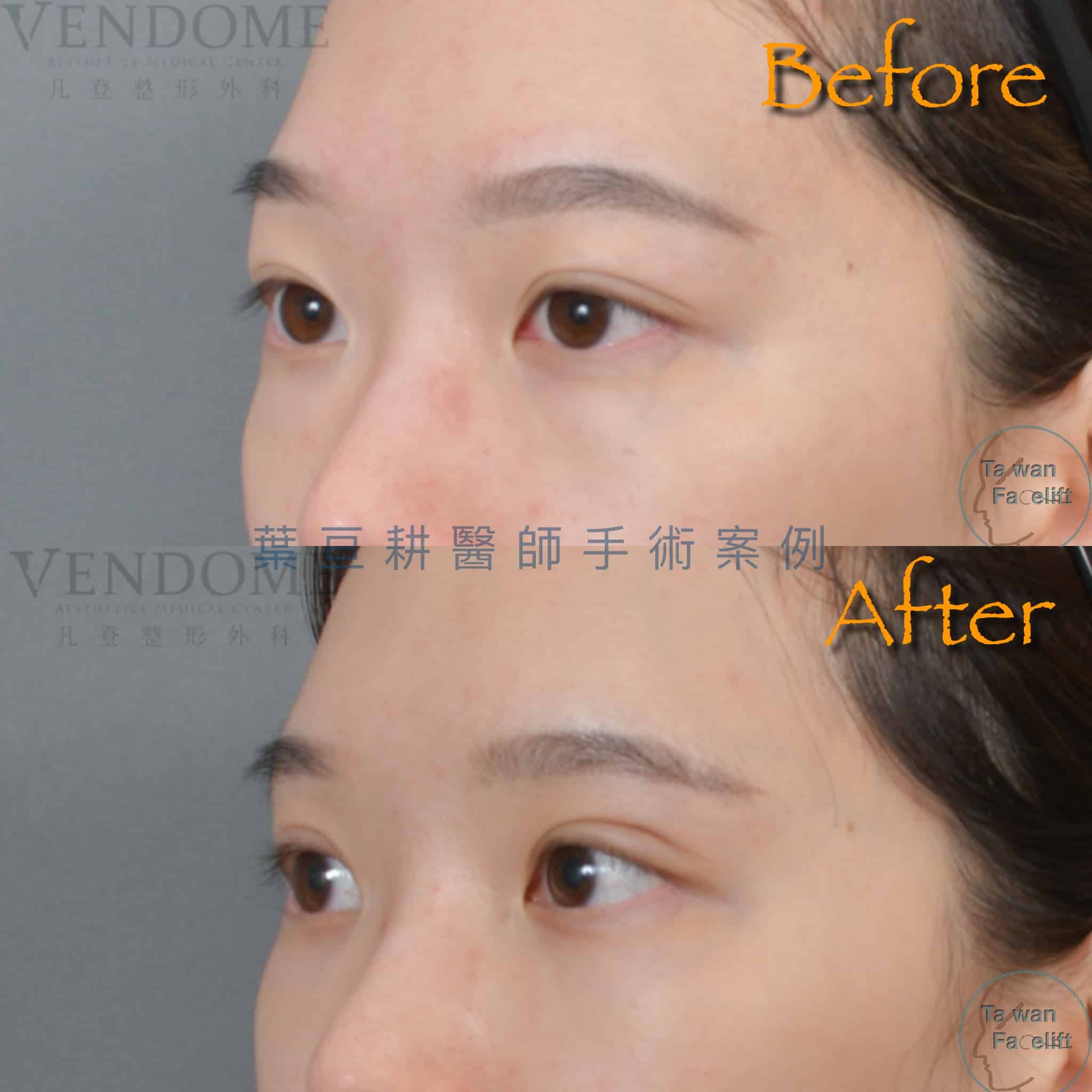 台南葉亘耕醫師雙眼皮重修手術後，調整提眼瞼肌與割雙眼皮，眼神明亮有神。