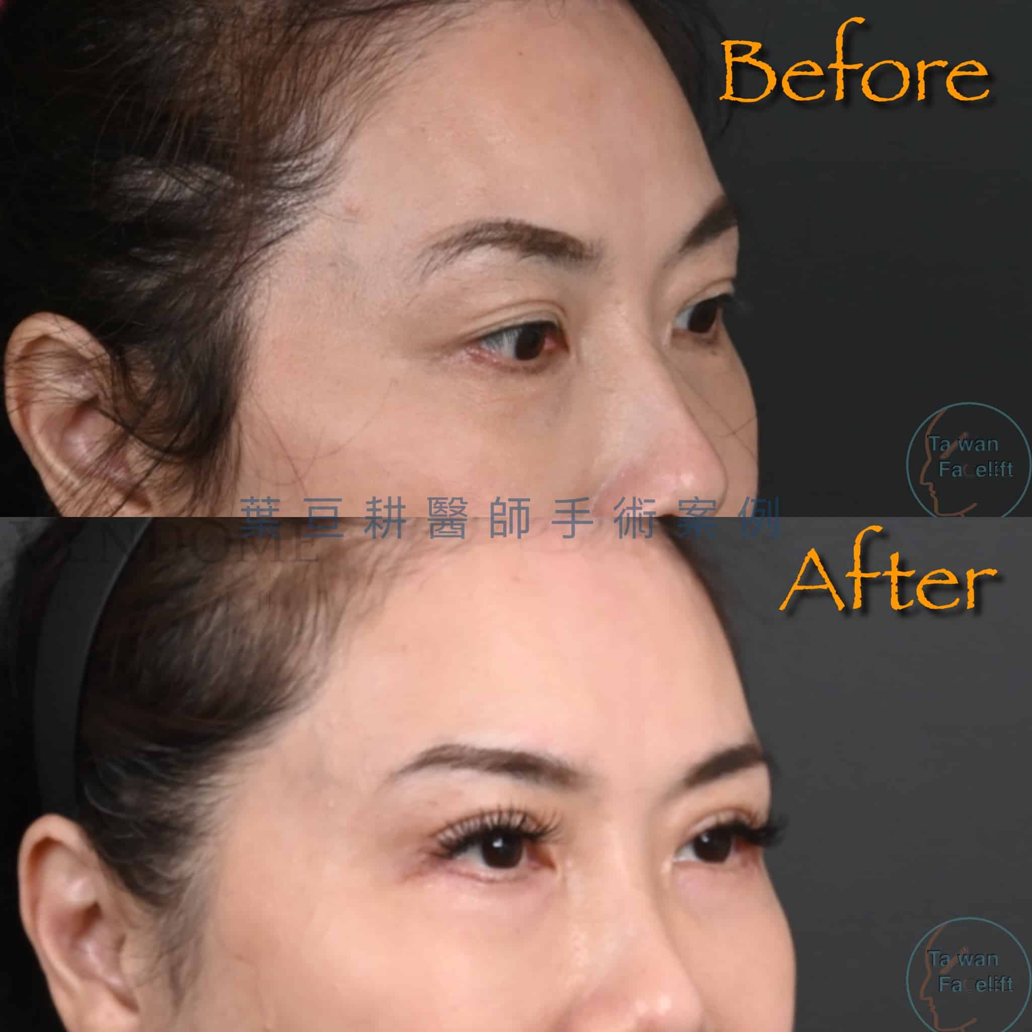 台南葉亘耕醫師雙眼皮重修手術後，多層眼皮改善為自然清晰單一摺痕。