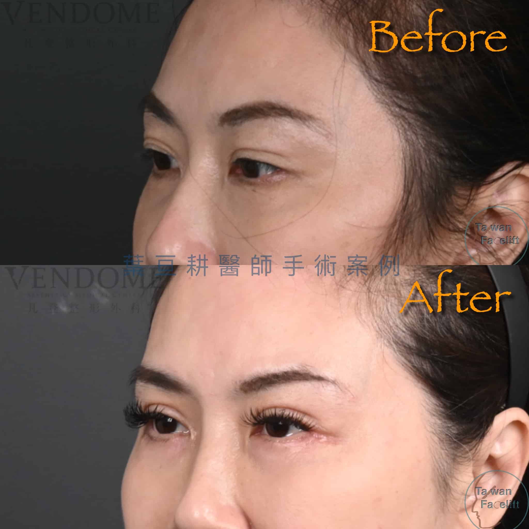 台南葉亘耕醫師雙眼皮重修手術後，多層眼皮改善為自然清晰單一摺痕。