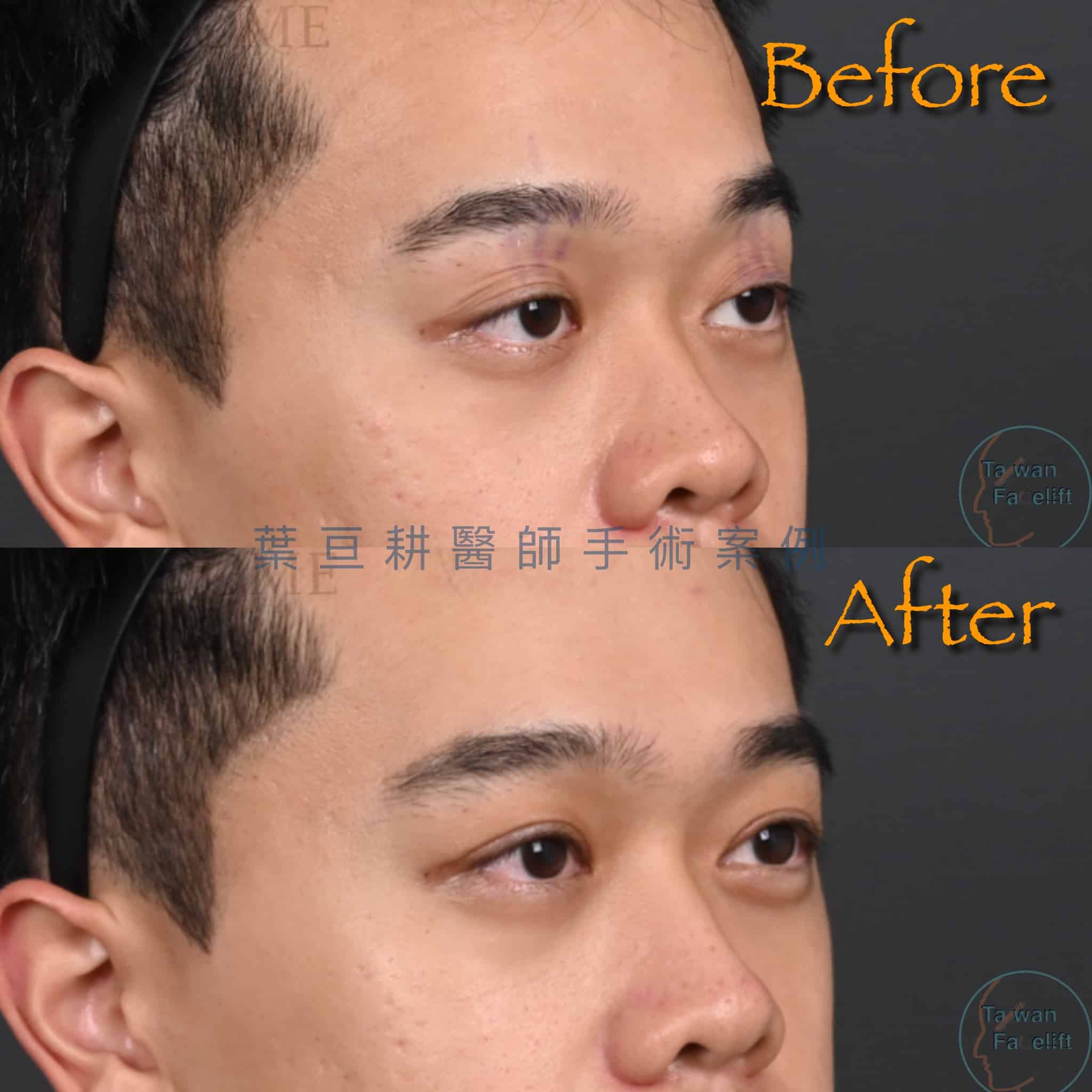 男性提眼瞼肌手術能讓疲憊眼神徹底改善，還你深邃有神雙眼