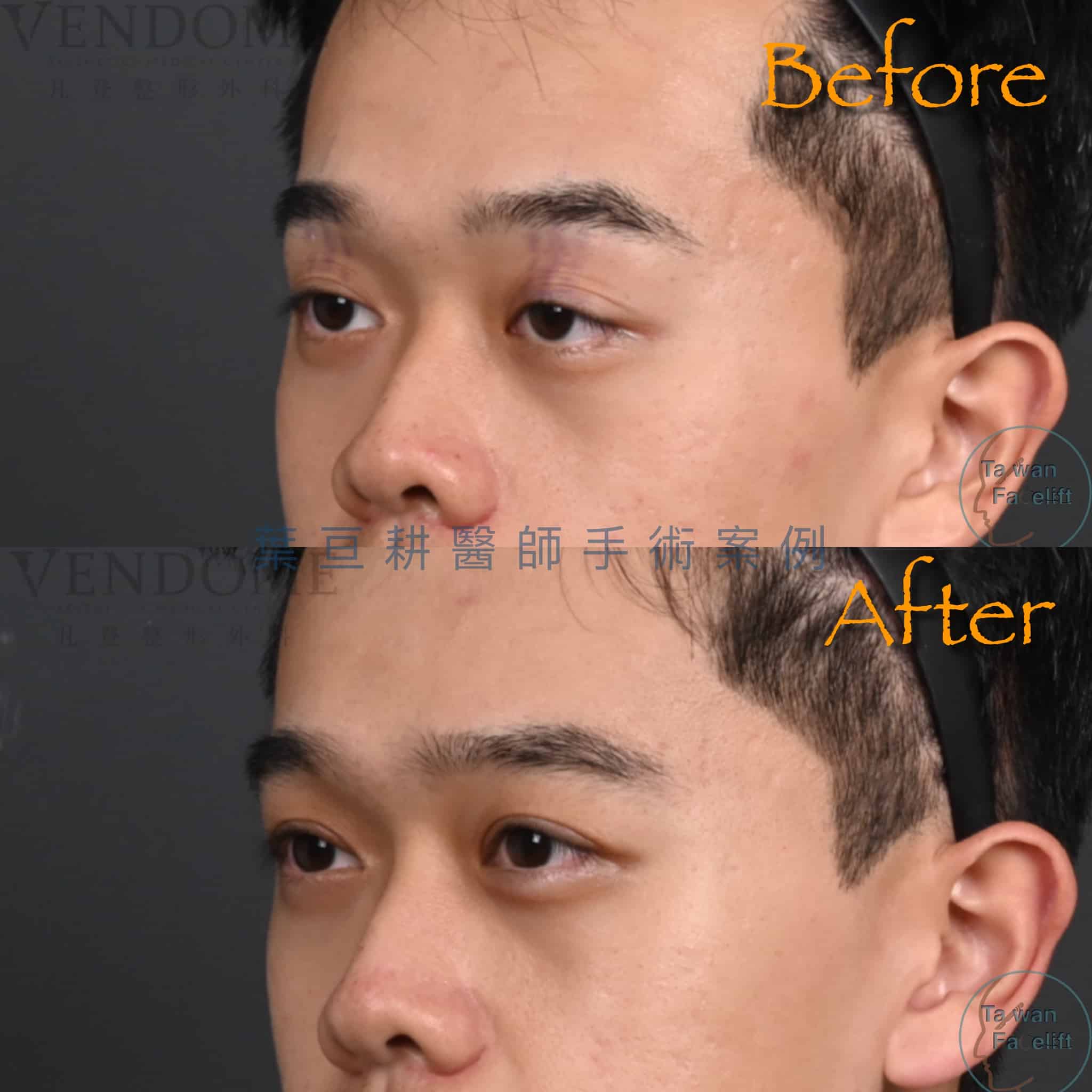 男性提眼瞼肌手術能讓疲憊眼神徹底改善，還你深邃有神雙眼