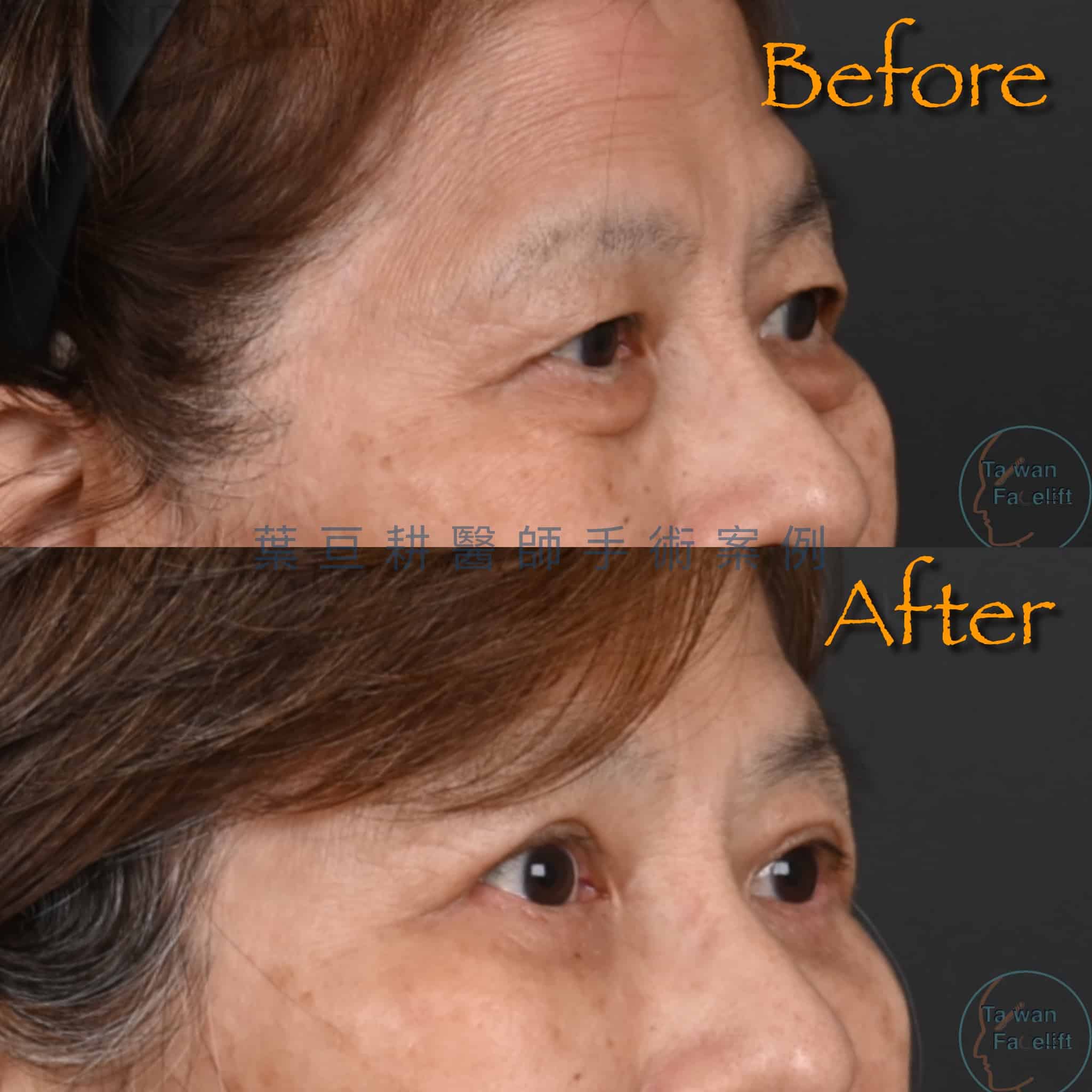 台南葉亘耕醫師提眼瞼肌矯正、割雙眼皮與眼袋外開手術後，雙眼明亮有神。