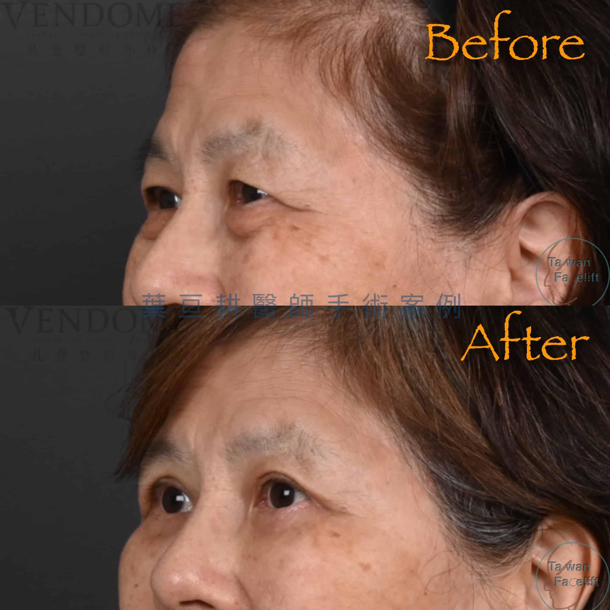 台南葉亘耕醫師提眼瞼肌矯正、割雙眼皮與眼袋外開手術後，雙眼明亮有神。