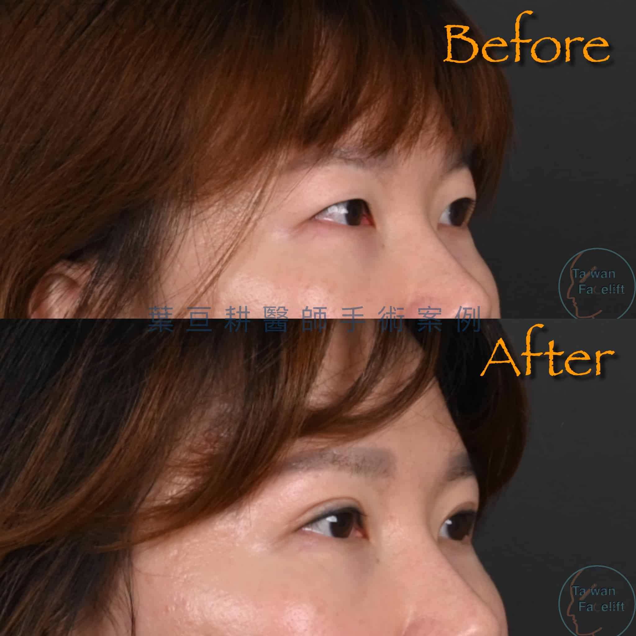 台南葉亘耕醫師割雙眼皮手術後，擁有自然深邃雙眼皮，眼神明亮。