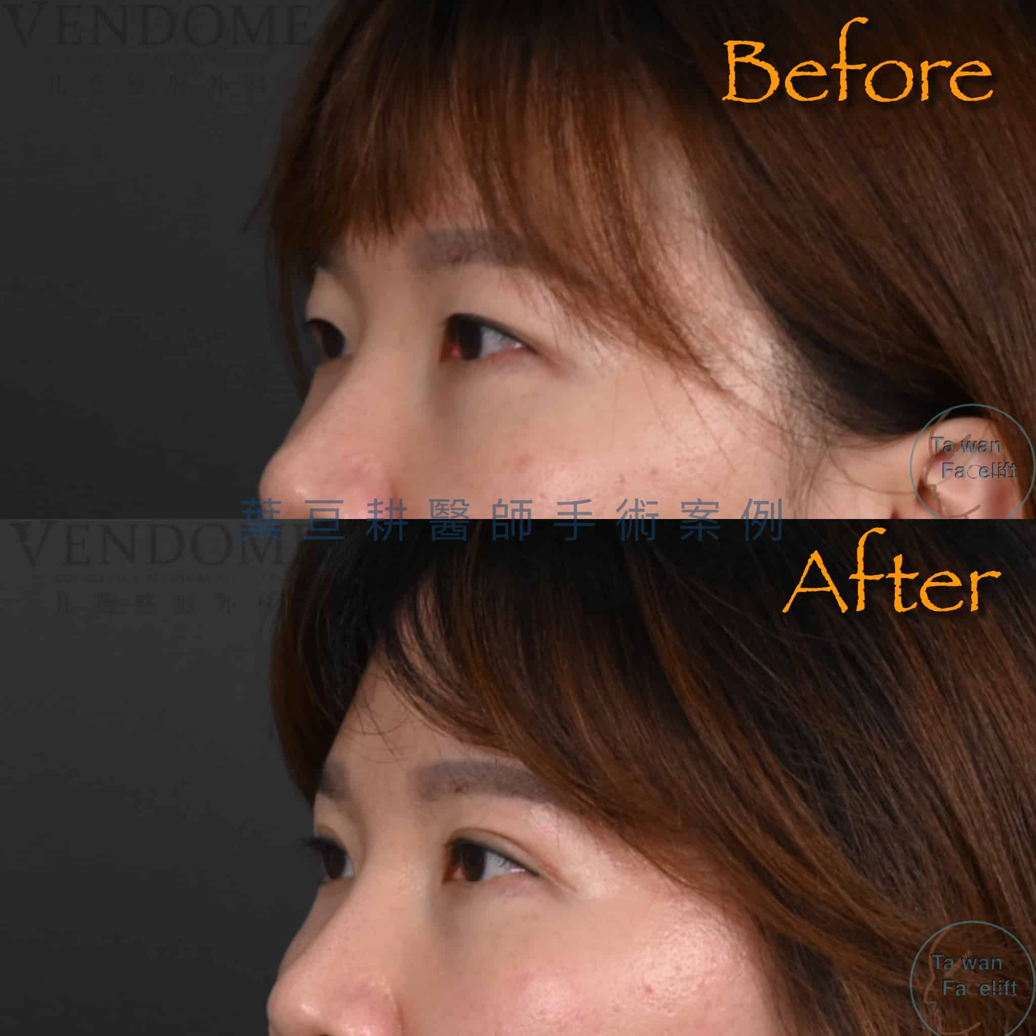 台南葉亘耕醫師割雙眼皮手術後，擁有自然深邃雙眼皮，眼神明亮。