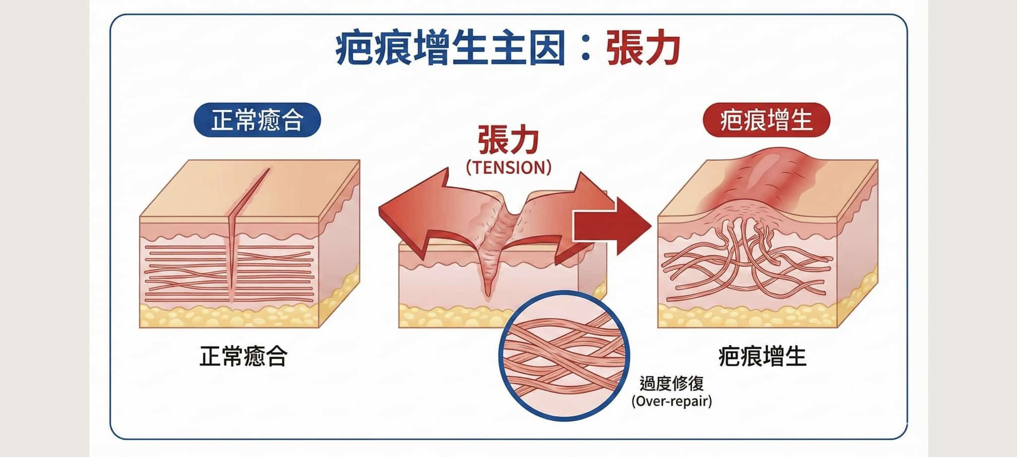 拉皮手術會有疤痕嗎?台南葉醫師揭秘隱痕關鍵:張力在筋膜不在皮膚 1 形成疤痕增生最主要的因素是張力