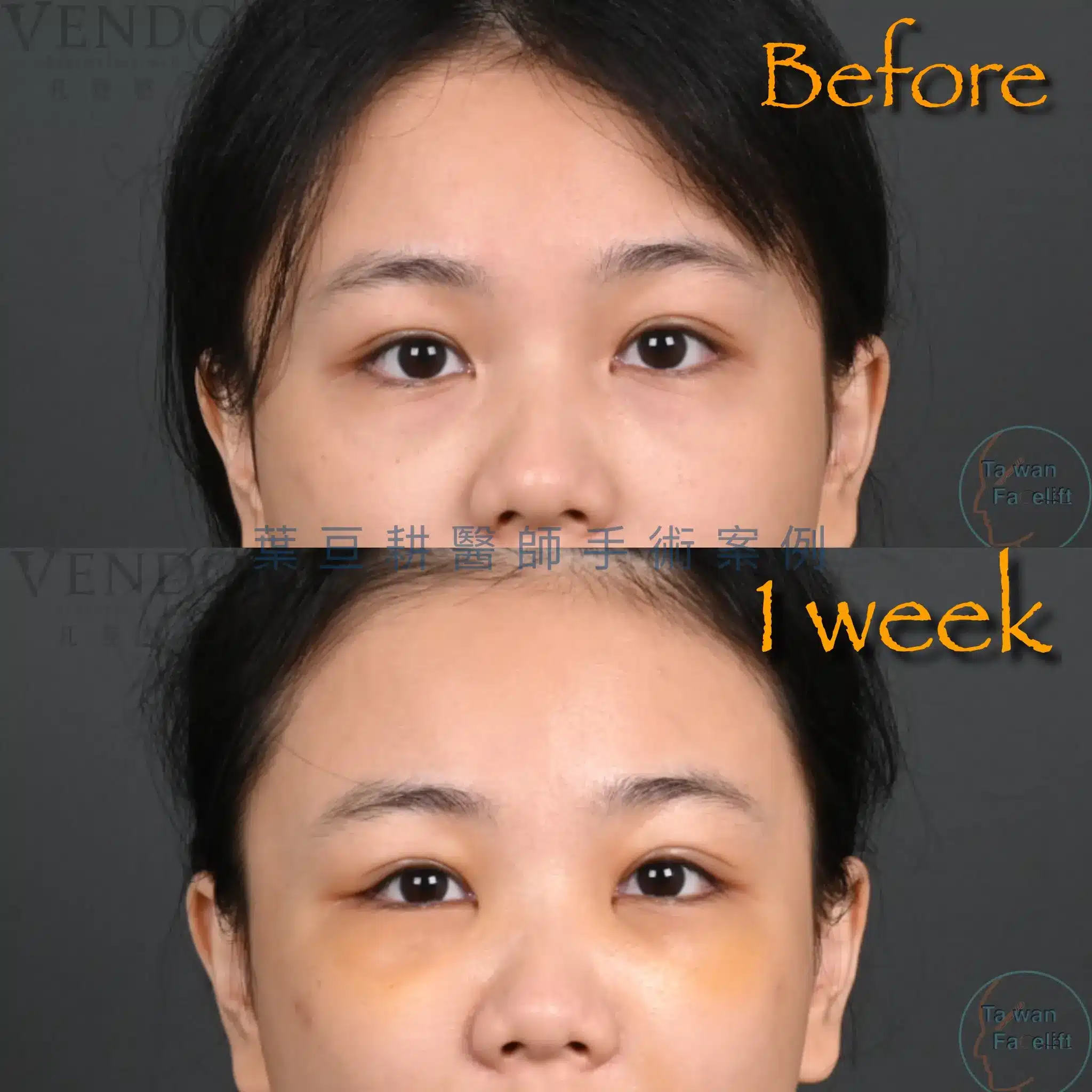 眼袋手術恢復期全攻略:內開外開腫幾天?葉亘耕醫師解析術後照顧與隱形眼鏡配戴時機 2 眼袋內開復原腫脹約一週