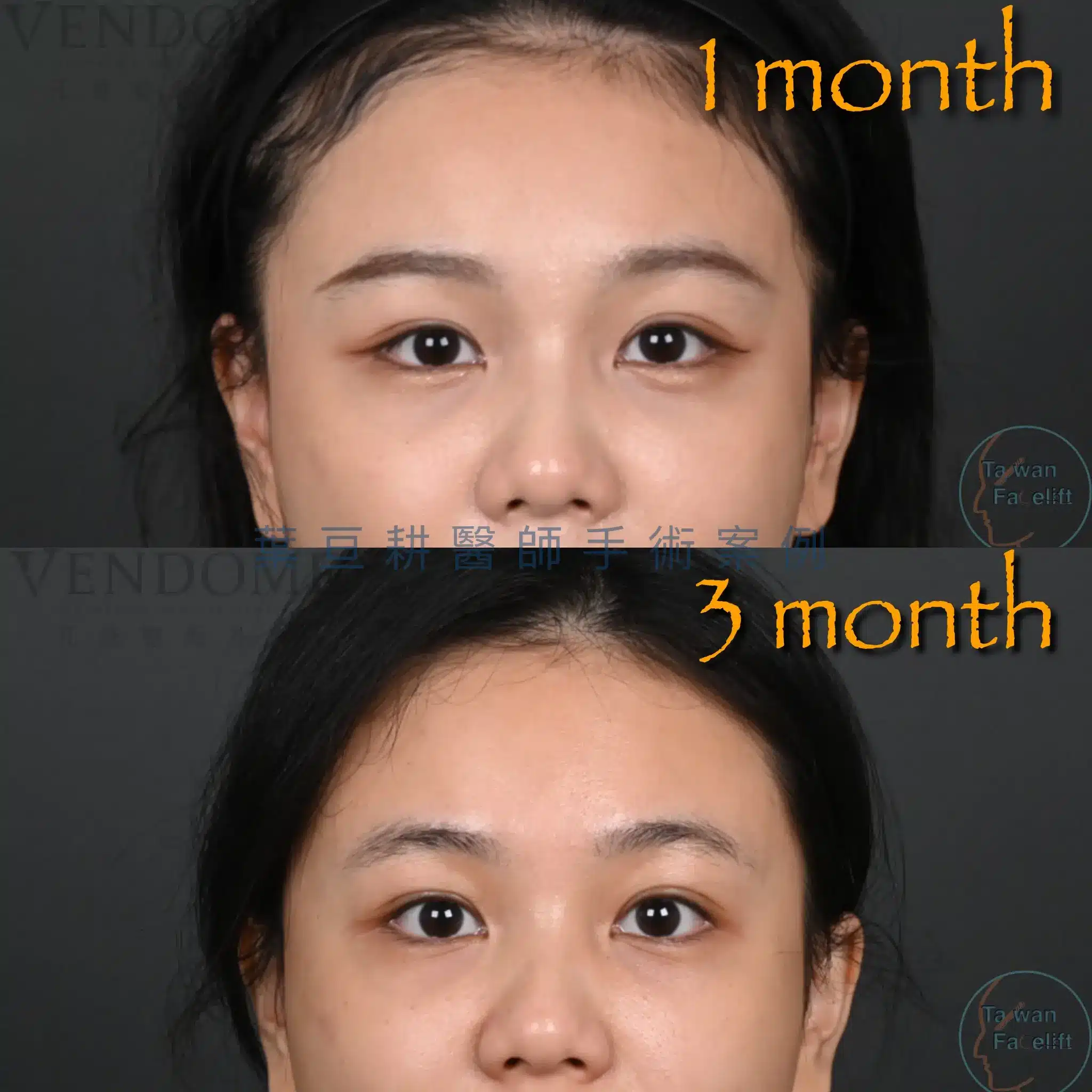 眼袋手術恢復期全攻略:內開外開腫幾天?葉亘耕醫師解析術後照顧與隱形眼鏡配戴時機 3 眼袋內開復原一個月只剩些微腫脹 三個月完全自然