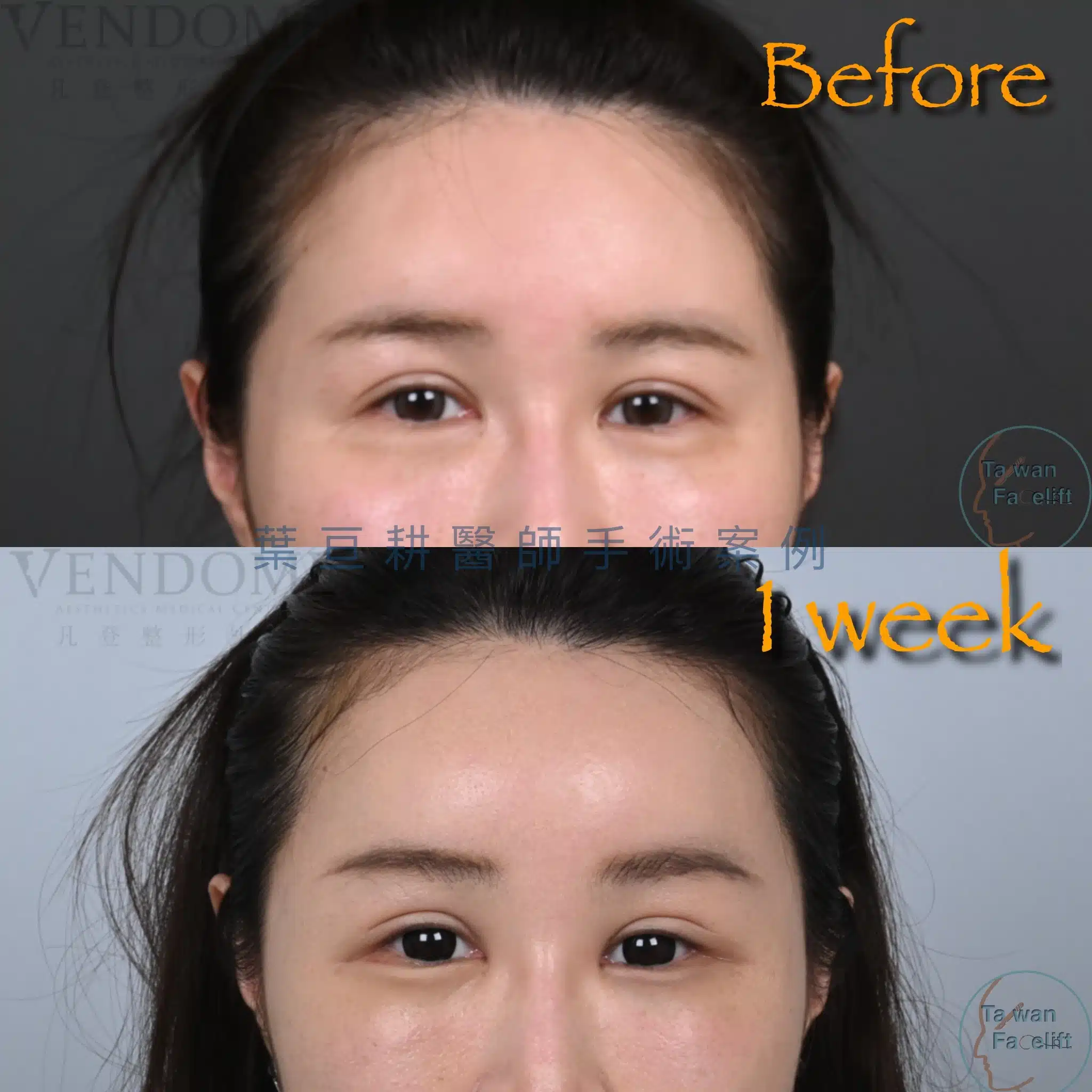 內視鏡提眉恢復期全解析:腫脹滿意度高?醫師破除迷思,詳解麻木感與五爪勾恢復過程 2 前額拉皮術後一周只有前額輕微腫脹,眼下輕微瘀血腫脹