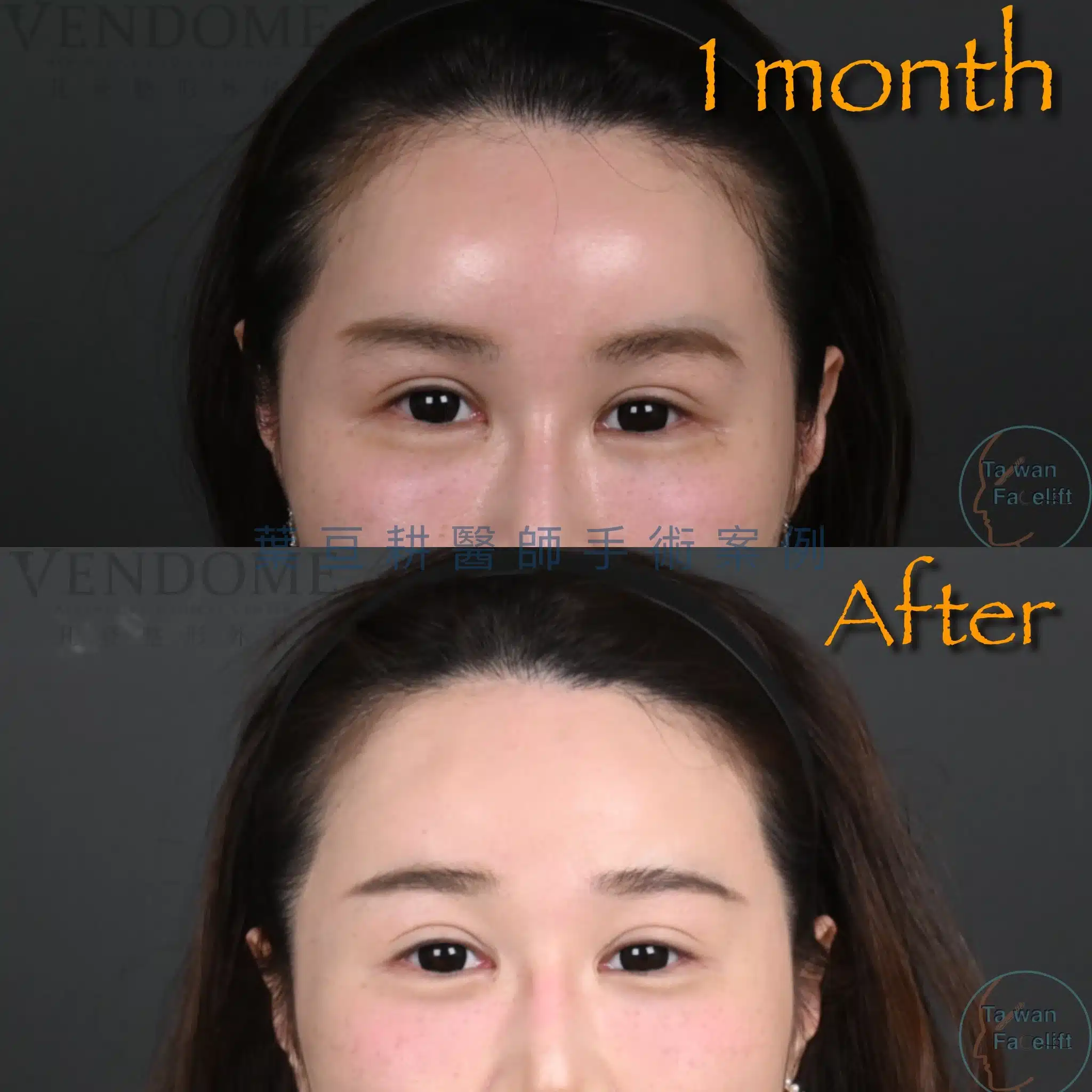 內視鏡提眉恢復期全解析:腫脹滿意度高?醫師破除迷思,詳解麻木感與五爪勾恢復過程 3 前額拉皮術後一個月腫脹已消退九成,術後七個月成效持久