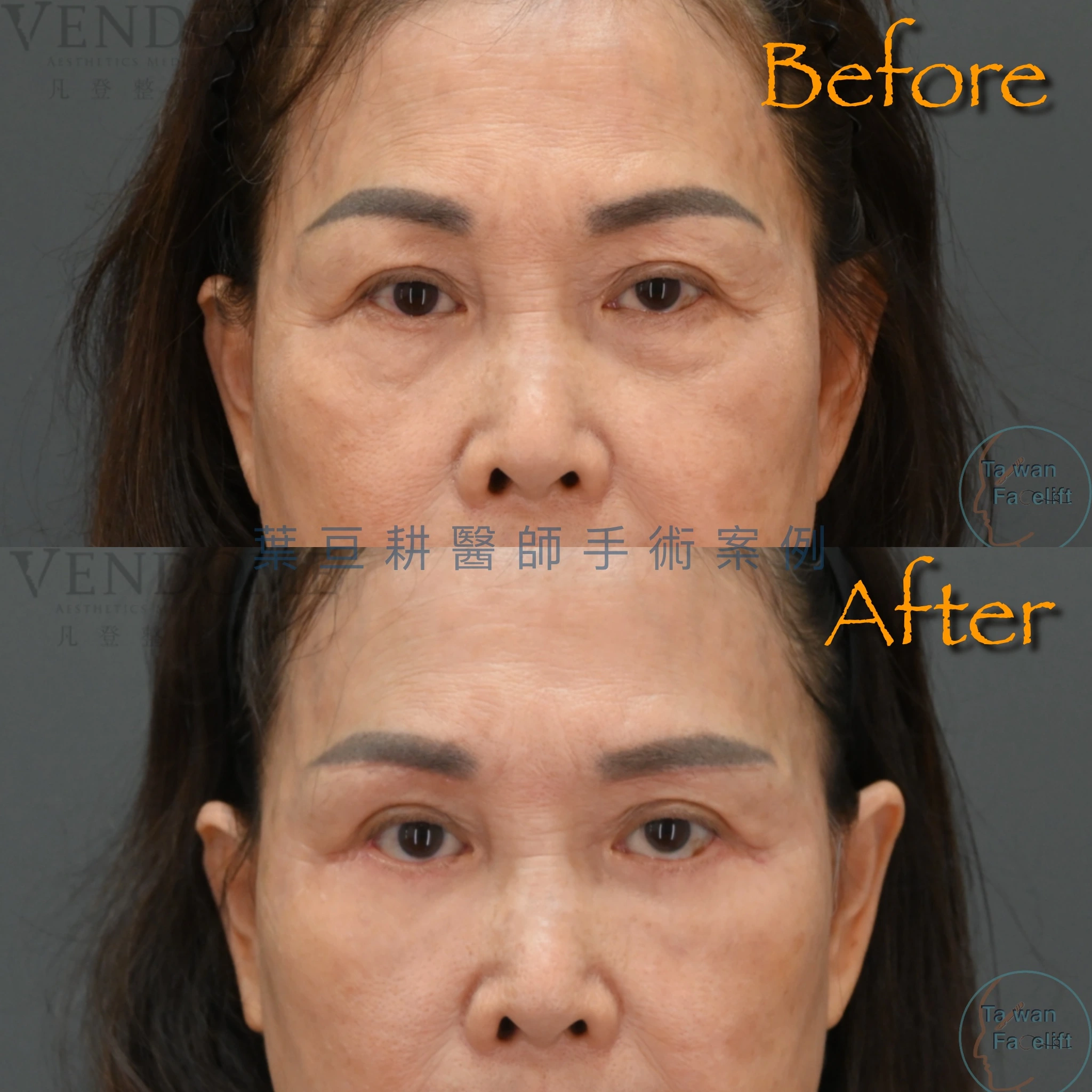 眉下切皮手術全攻略:手術前避開後悔地雷,優缺點、費用與疤痕解析 3 眉下切皮手術可以切除外側多餘下垂的眼皮