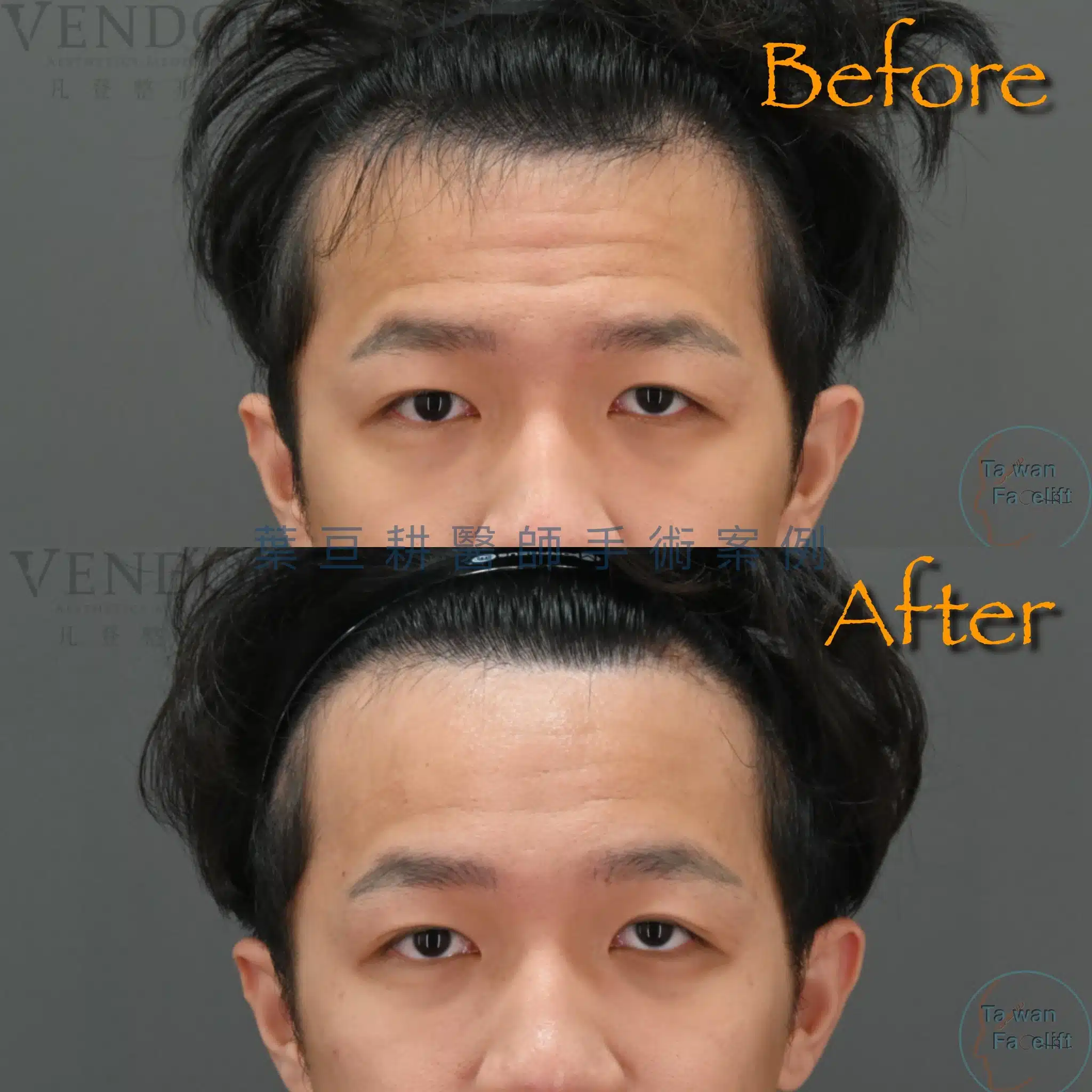 抬頭紋很深怎麼辦?解析抬頭紋原因、消除方案與醫美肉毒手術全指南 4 葉亘耕醫師內視鏡提眉手術後,改善抬頭紋、眉壓眼
