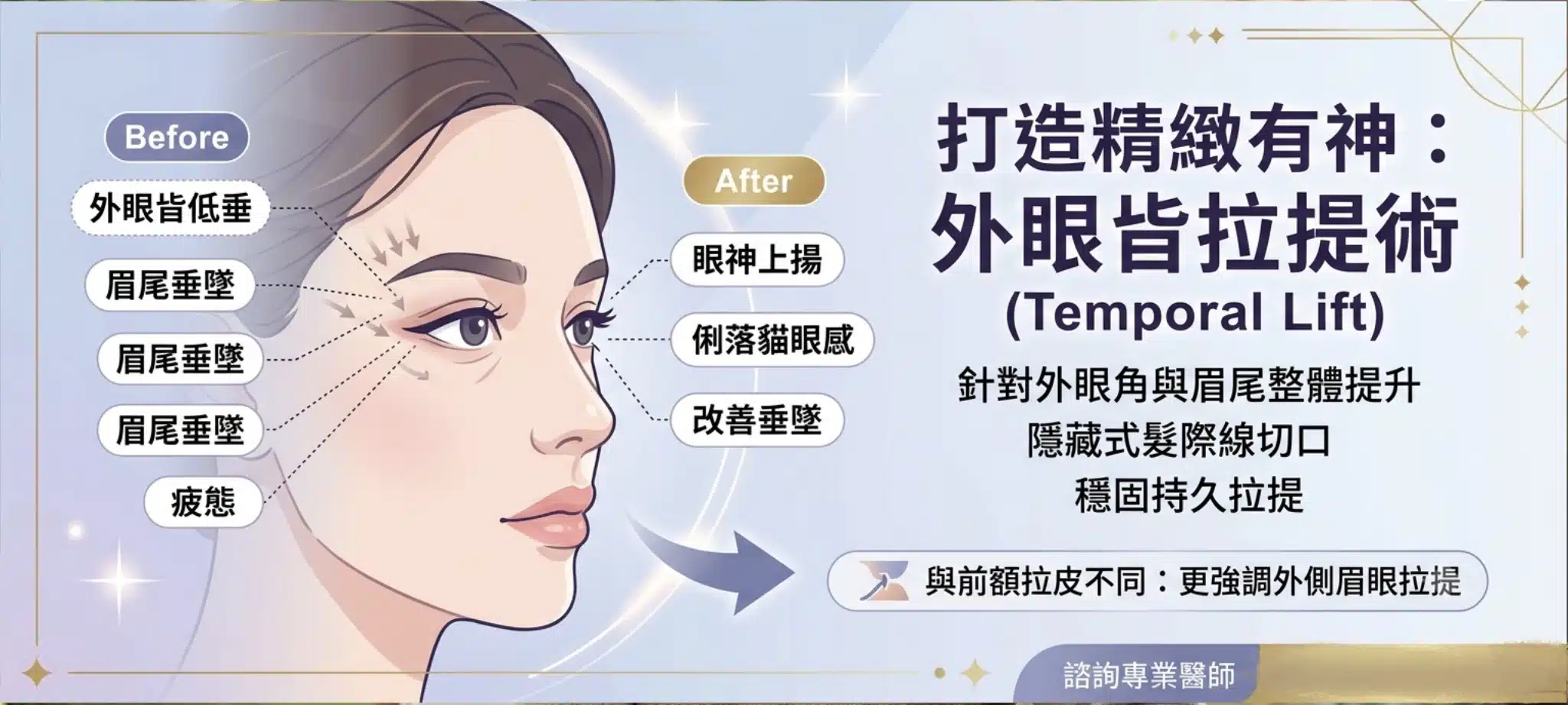 眼尾下垂顯老又無神?醫師解析3大眼尾下垂原因與改善眼尾下垂醫美手術(眉下切皮、顳側拉提、雙眼皮手術完整比較) 3 顳側拉皮可以改善眼尾下垂感