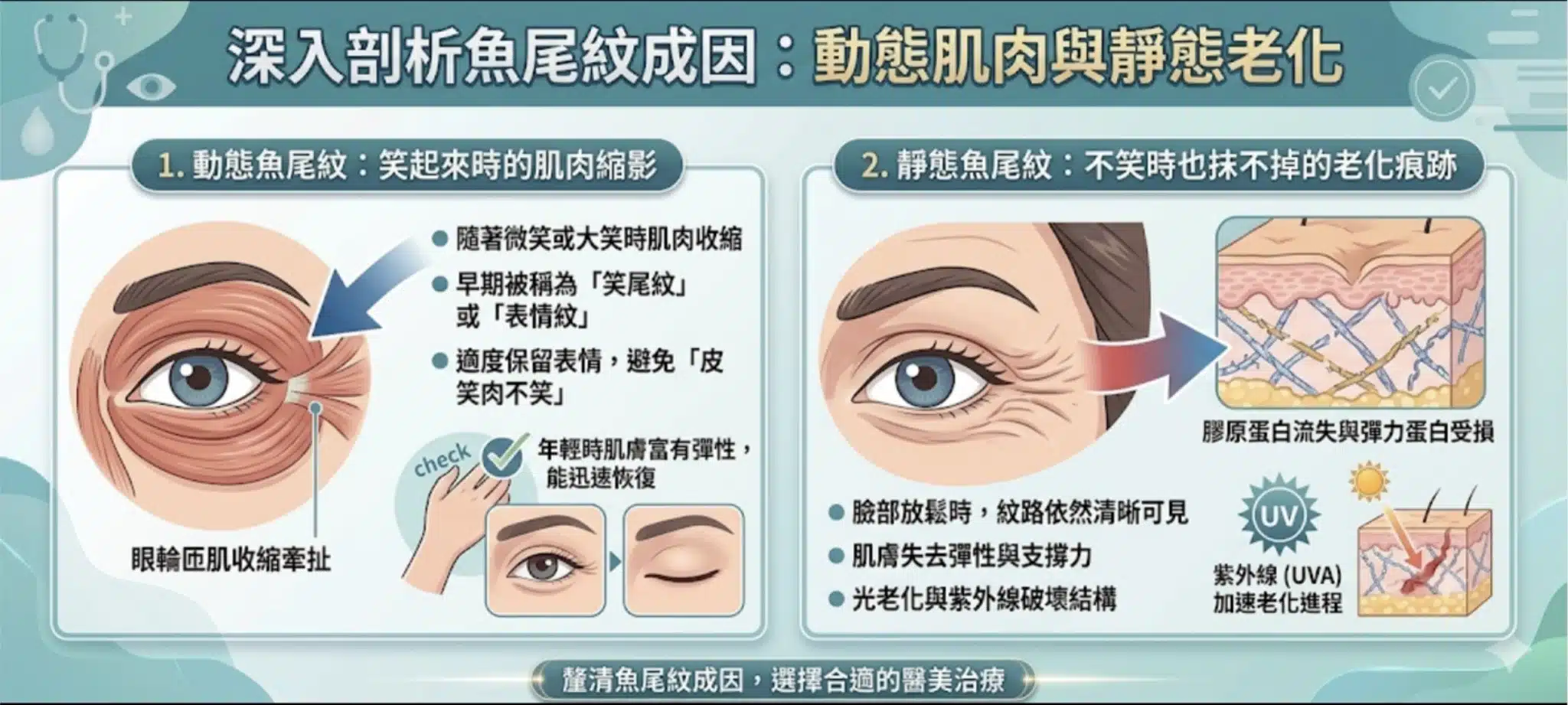 魚尾紋怎麼辦?從動態紋路到老化的靜態紋,醫美療程與日常保養全面解析 1 魚尾紋成因動態與靜態紋